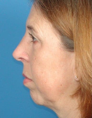 Rhinoplasty / Nose surgery