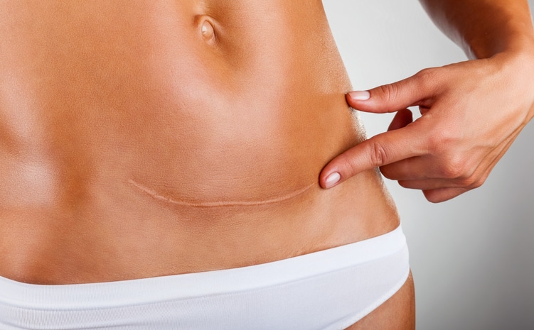 Scar Removal