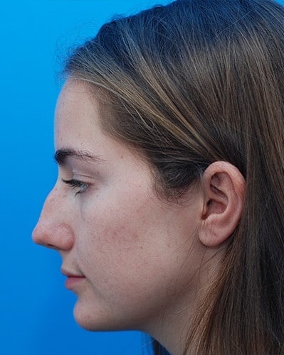 Rhinoplasty / Nose surgery