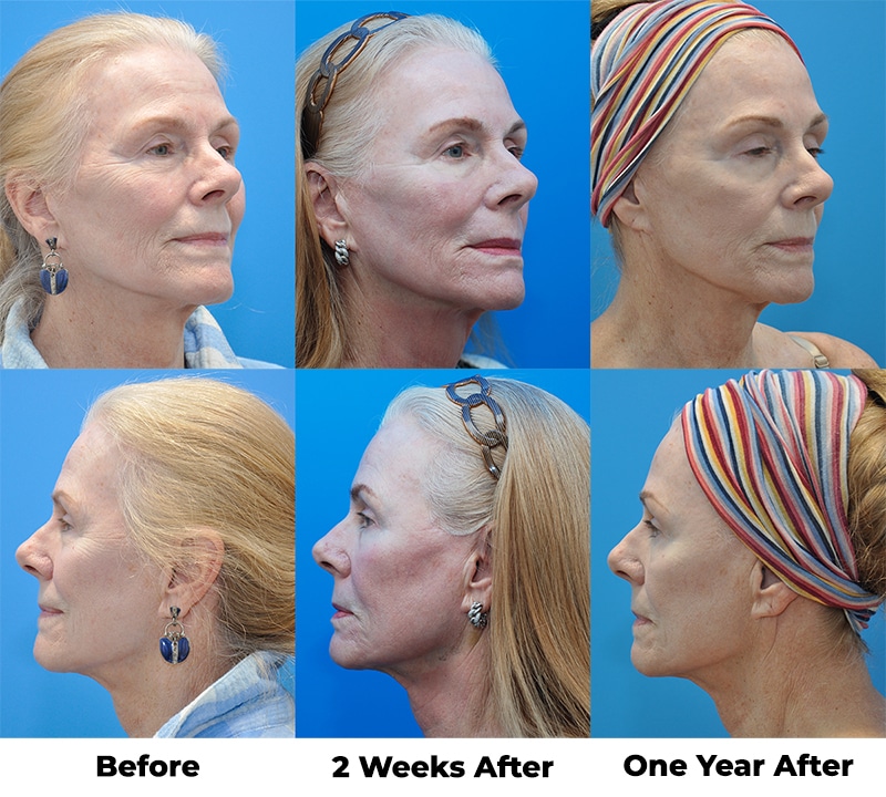 Sculptra Aesthetics Results layout