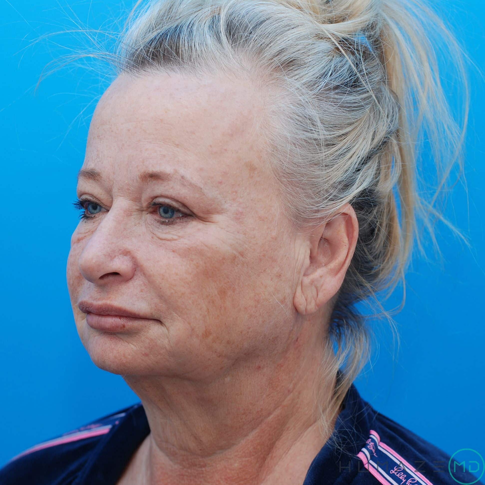 Eyelid Surgery / Blepharoplasty