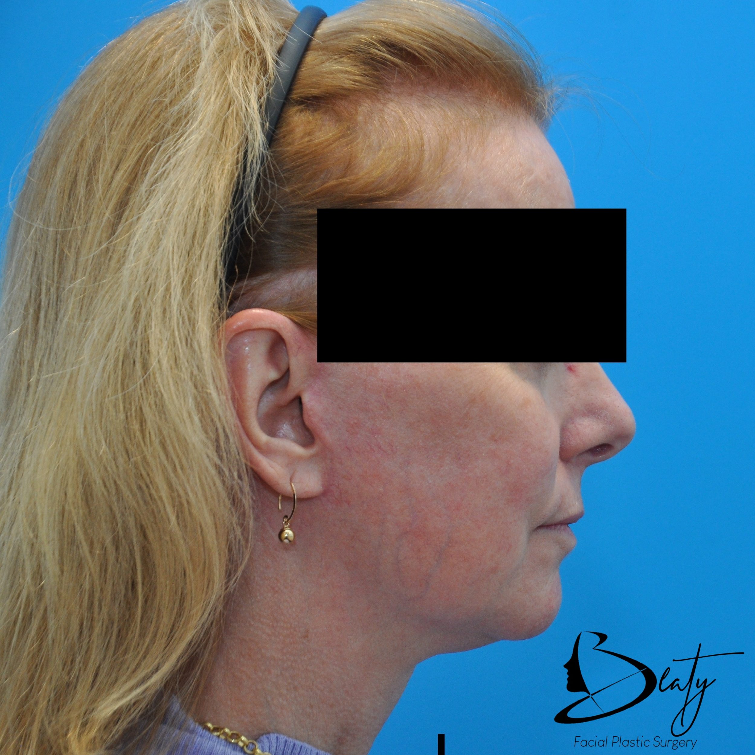 After Image