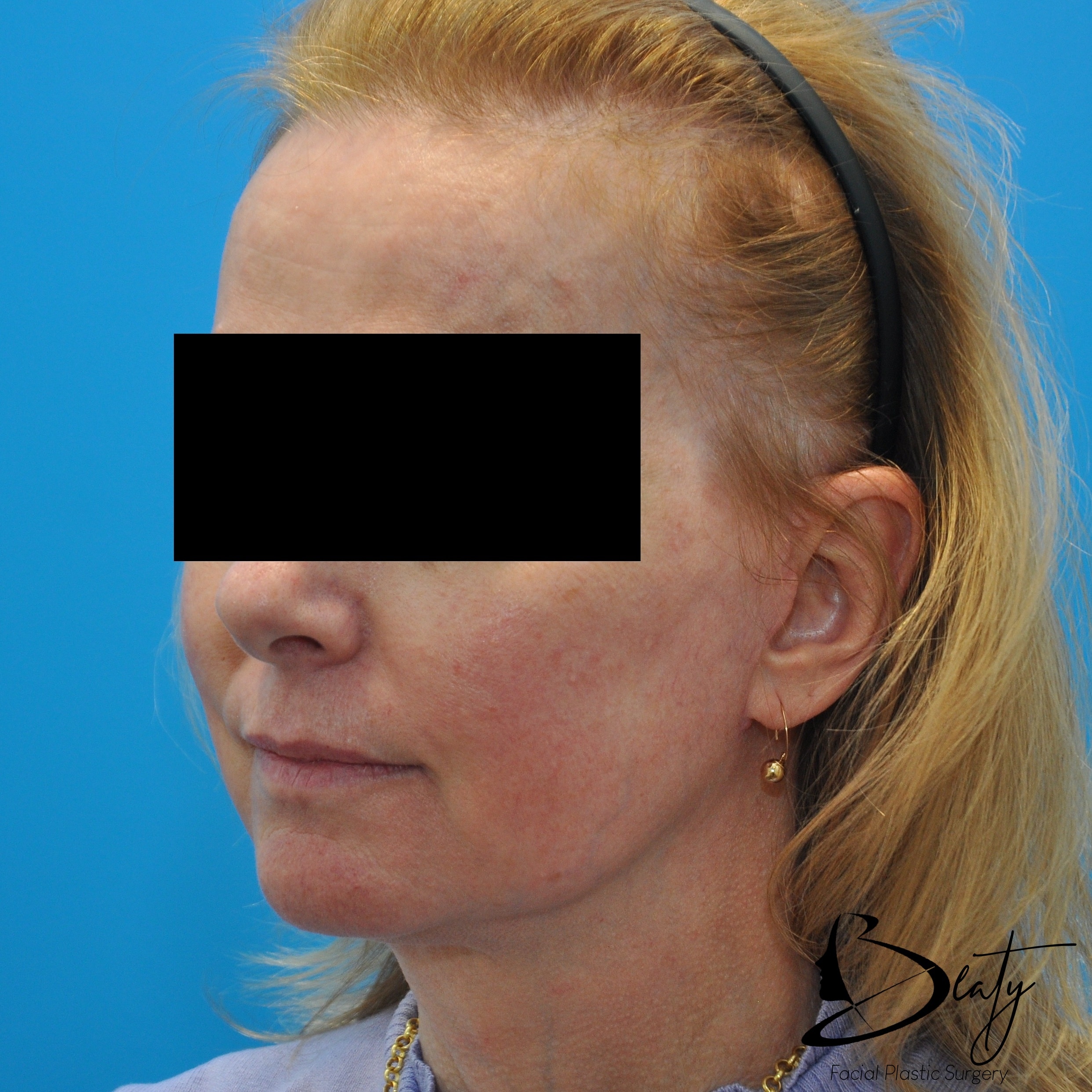 After Image