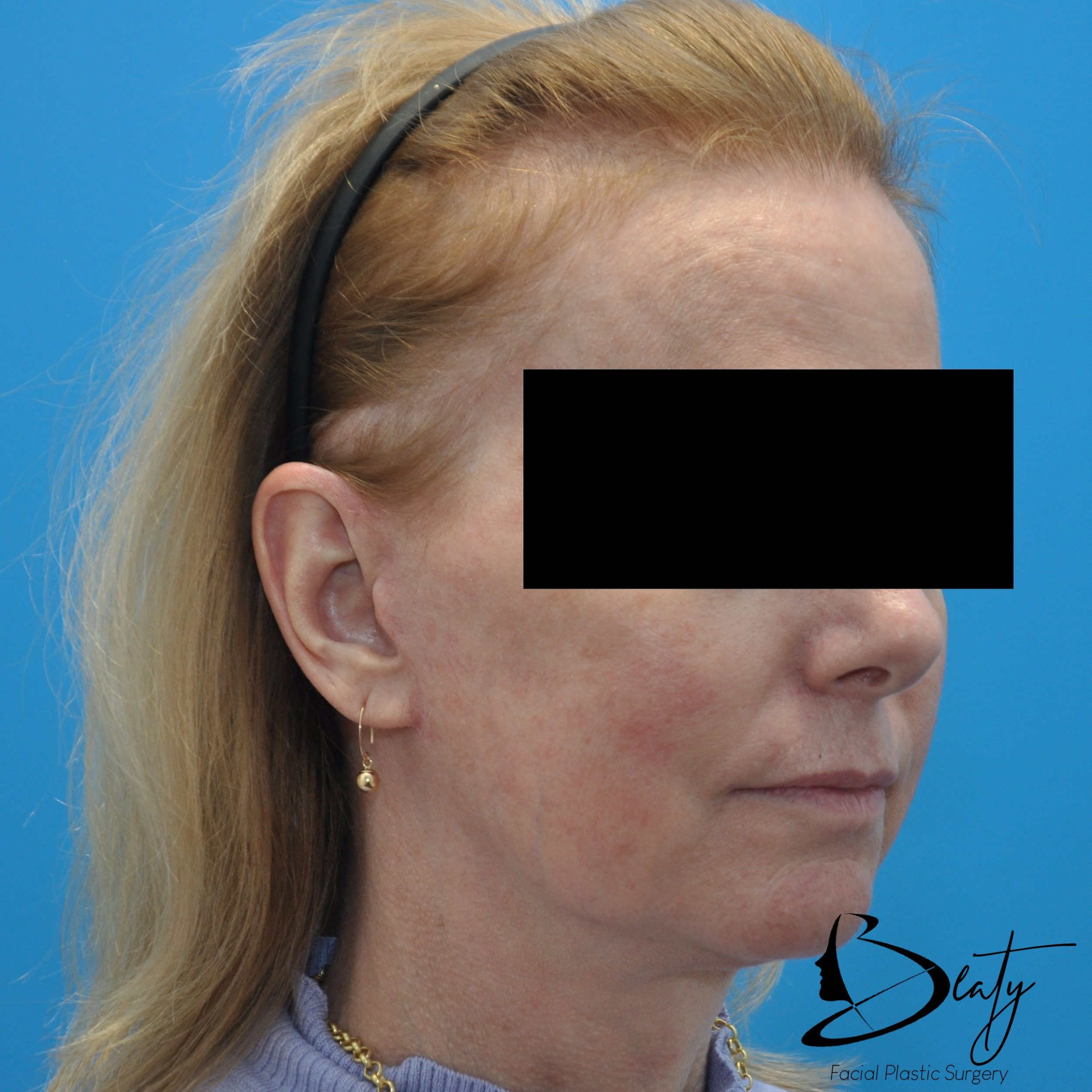 After Image
