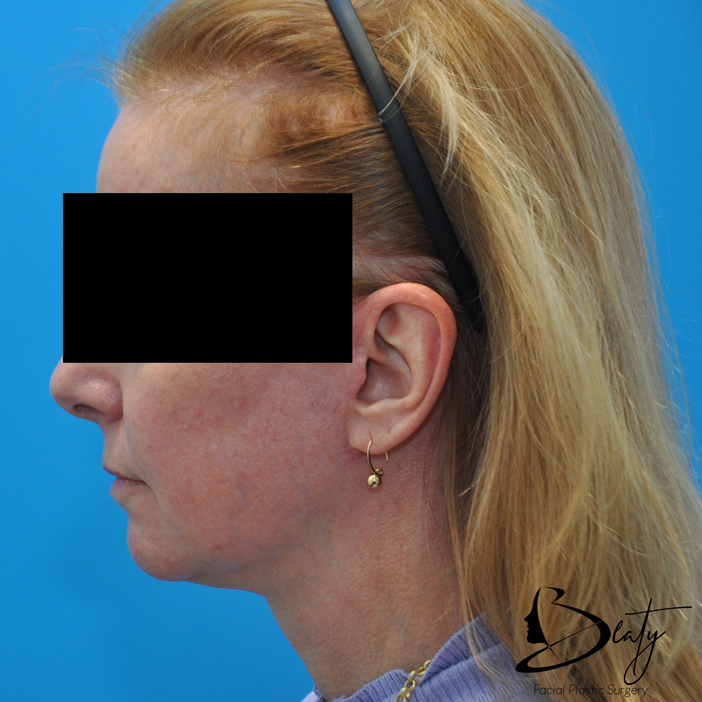 After Image