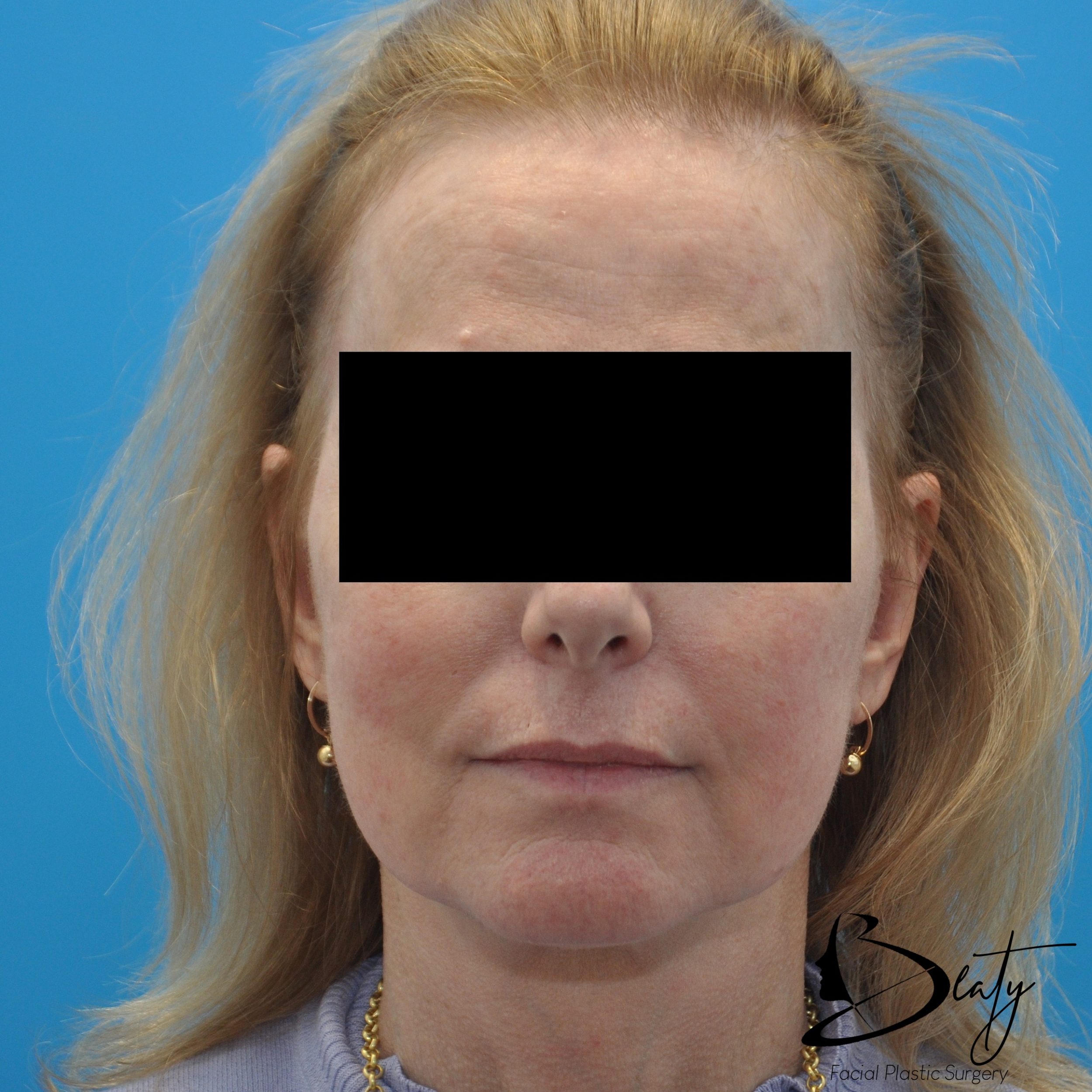 After Image