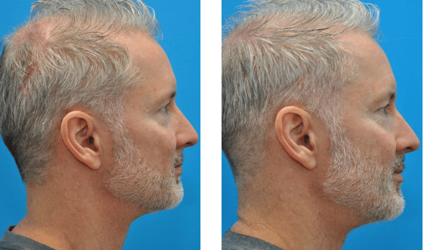 FireShot Capture 3121 IPL Atlanta GA Laser Skin Rejuvenation Photofacial Treatment www.beatymd.com FireShot Capture 3121 IPL Atlanta GA Laser Skin Rejuvenation Photofacial Treatment www.beatymd.com