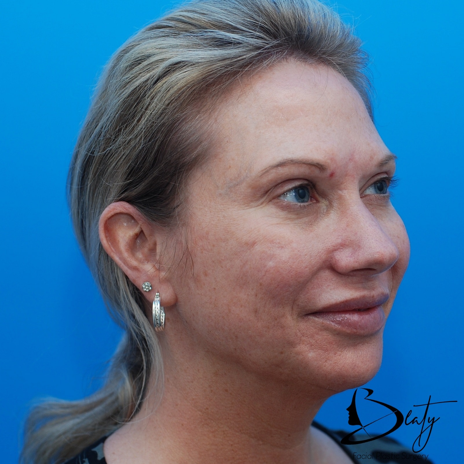 skin resurfacing