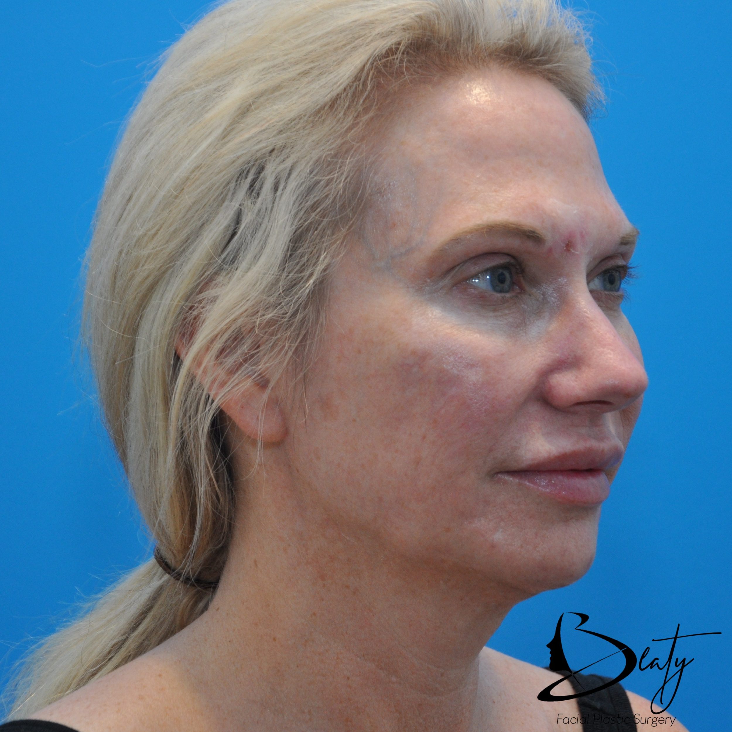 skin resurfacing