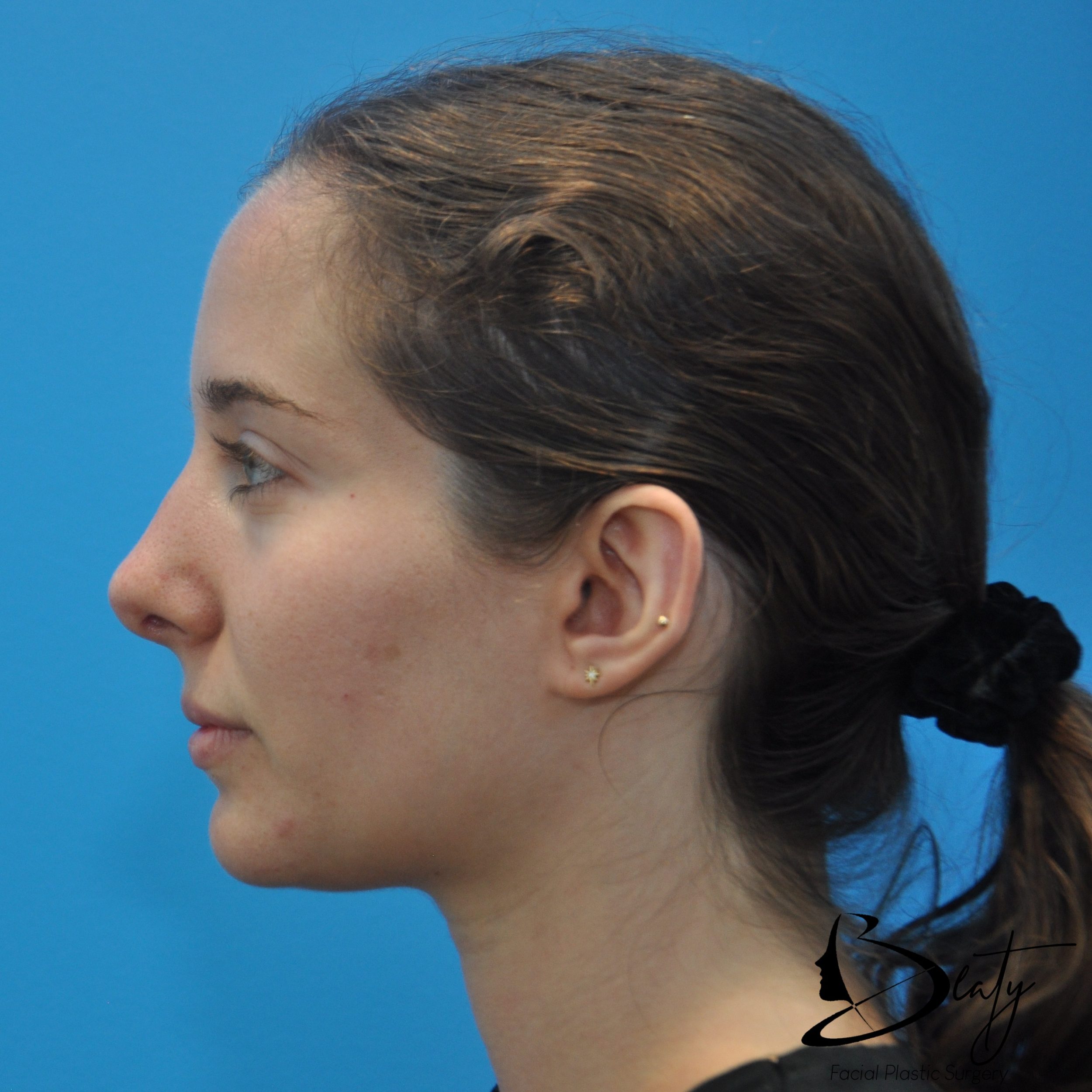 Rhinoplasty