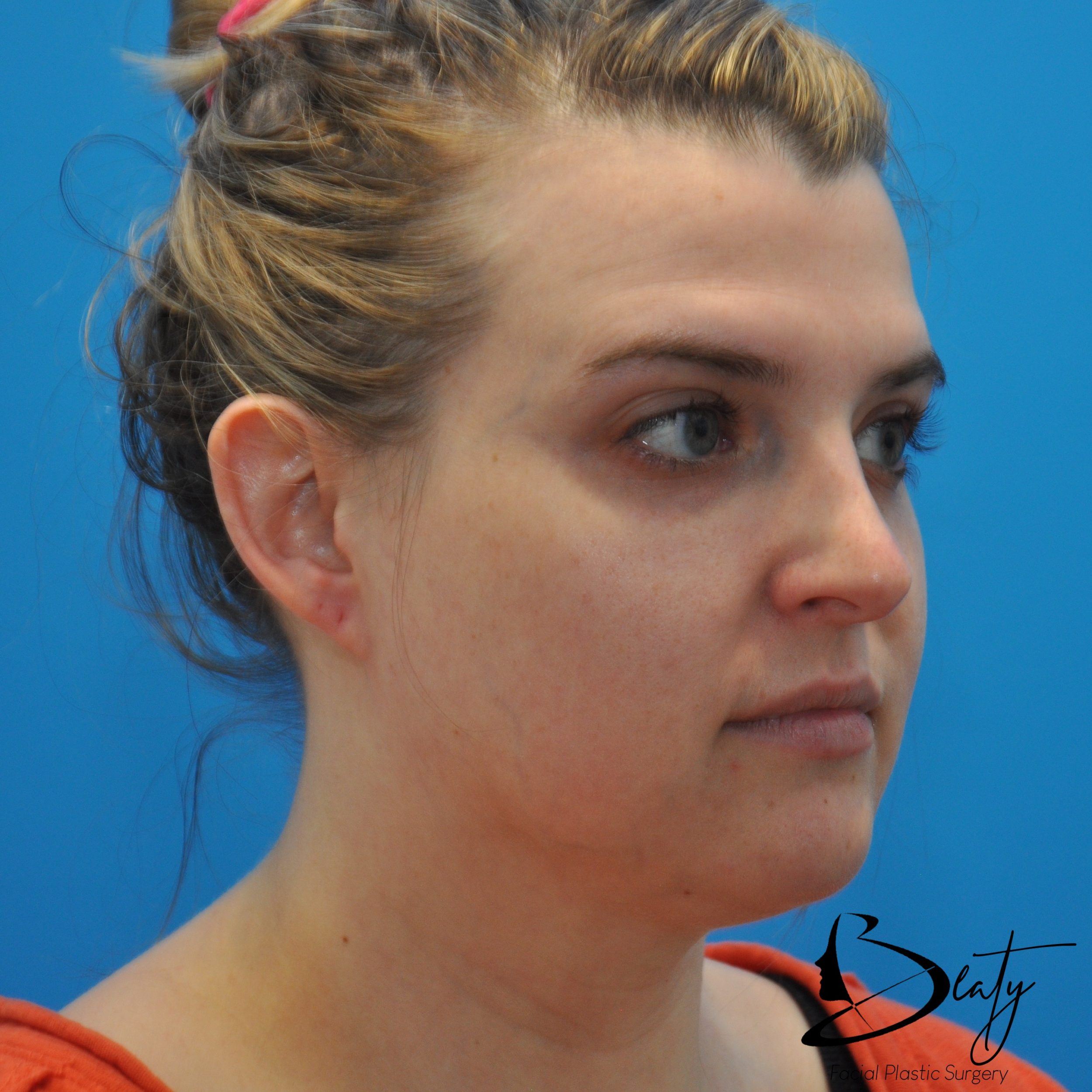 Before Image