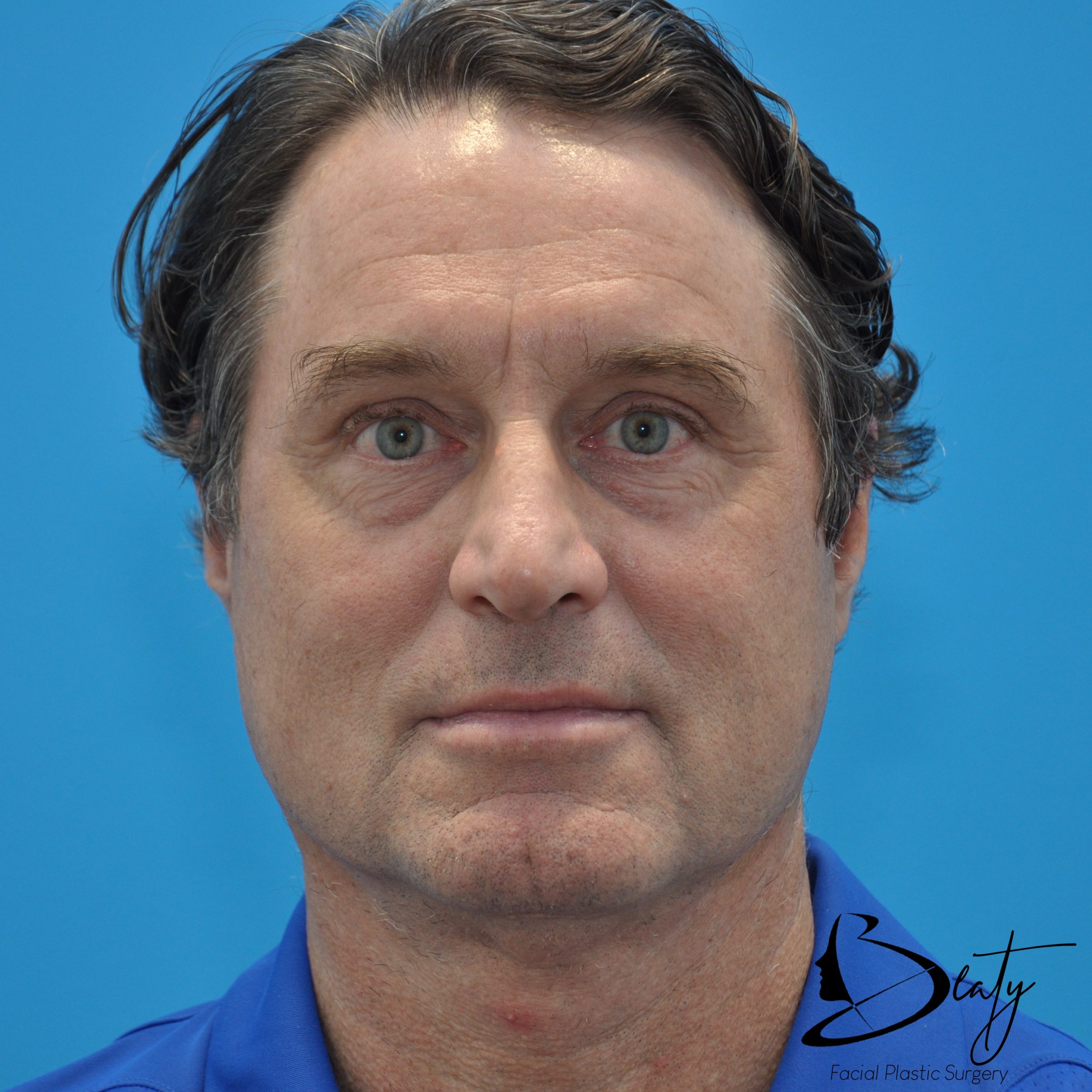 brow lift & upper blepharoplasty