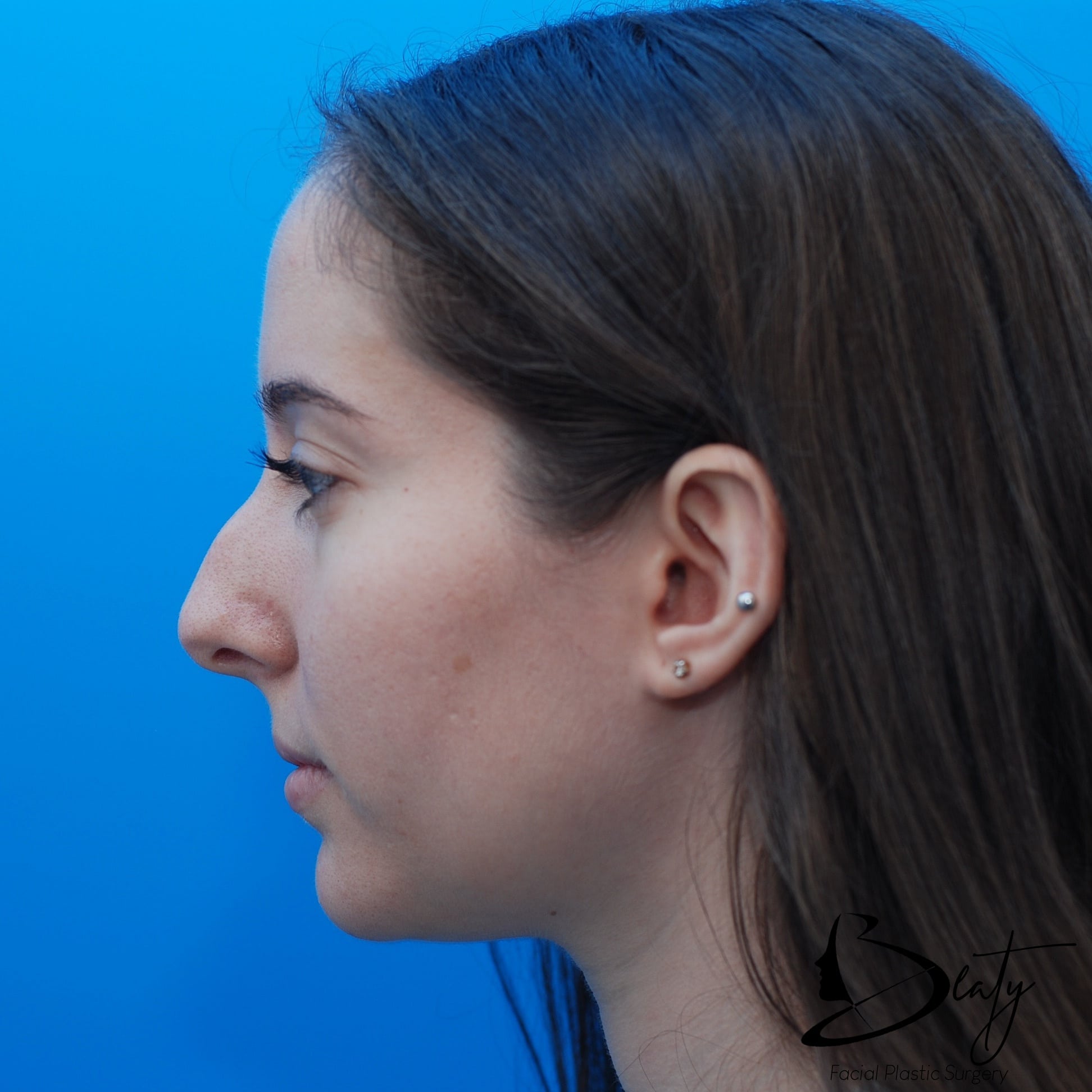 Rhinoplasty