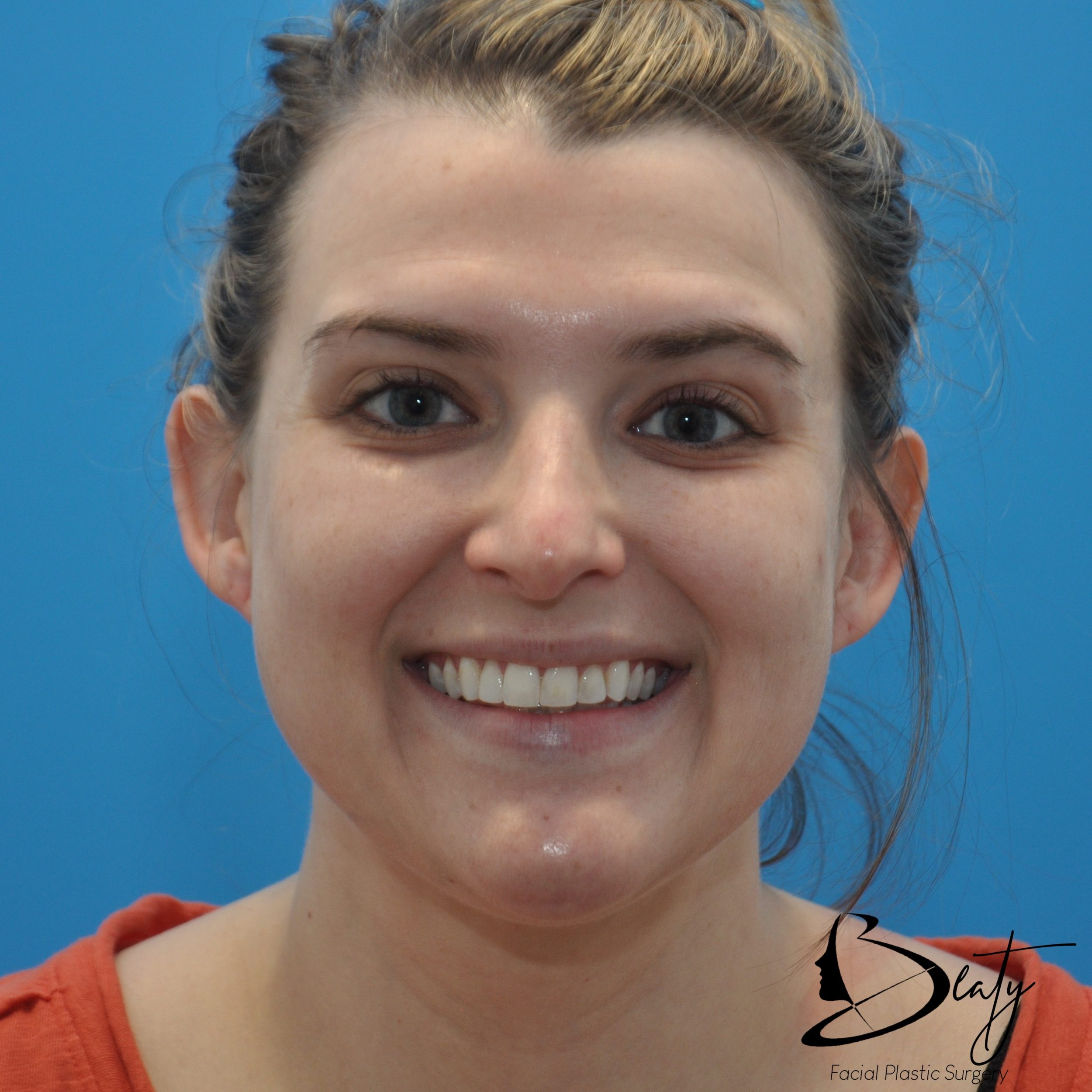 fillers & injectables