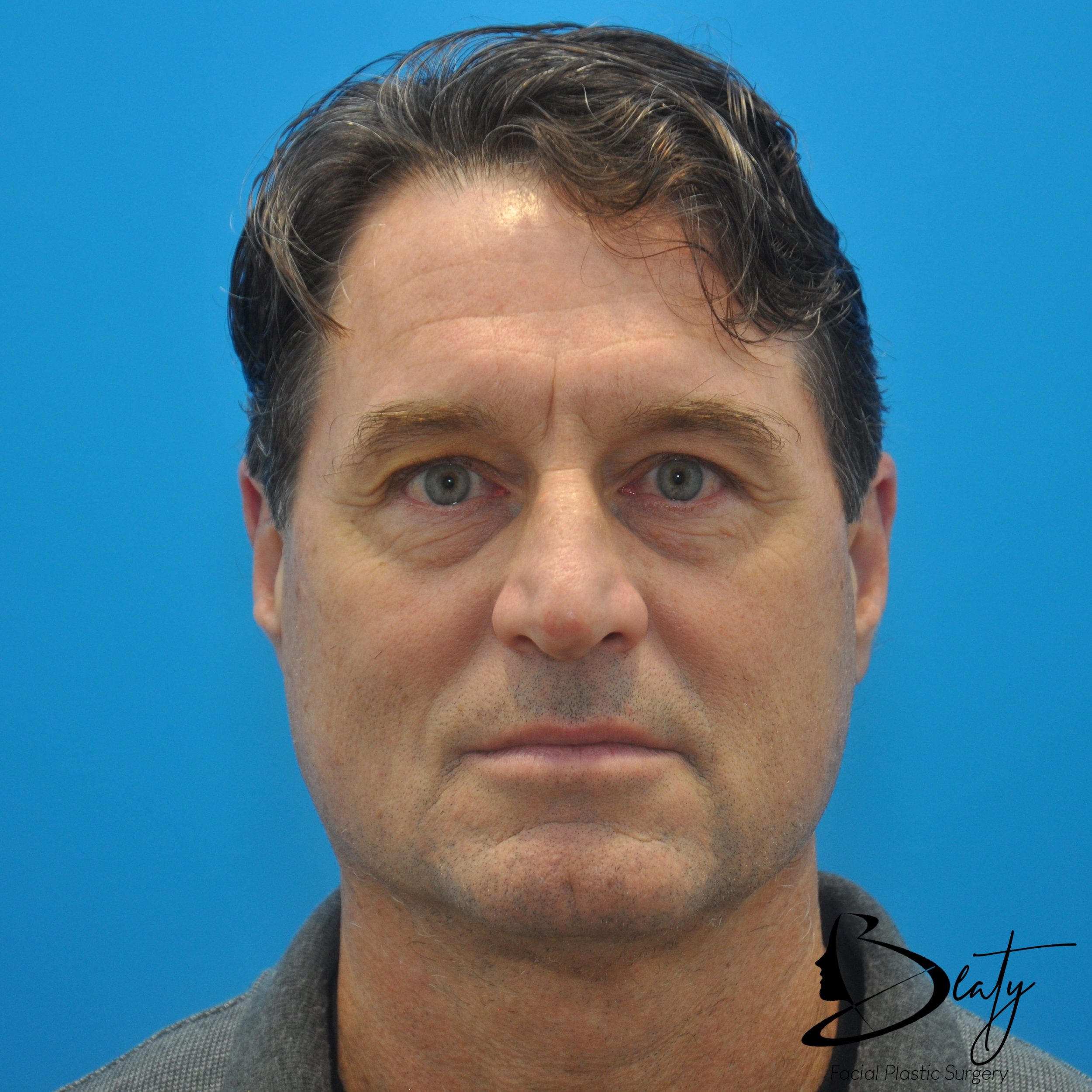 brow lift & upper blepharoplasty