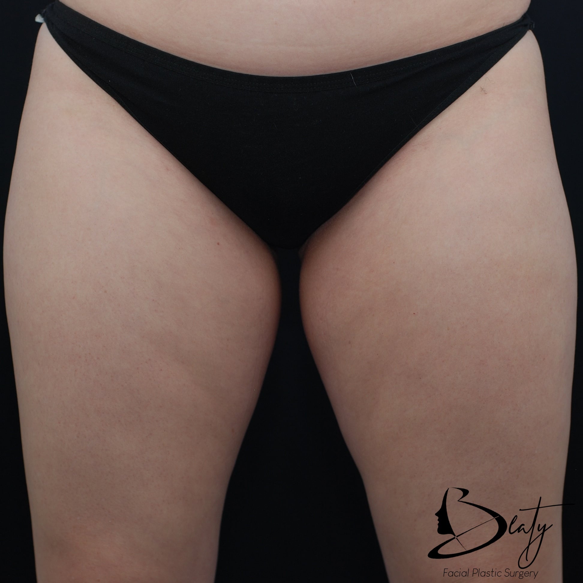 coolsculpting