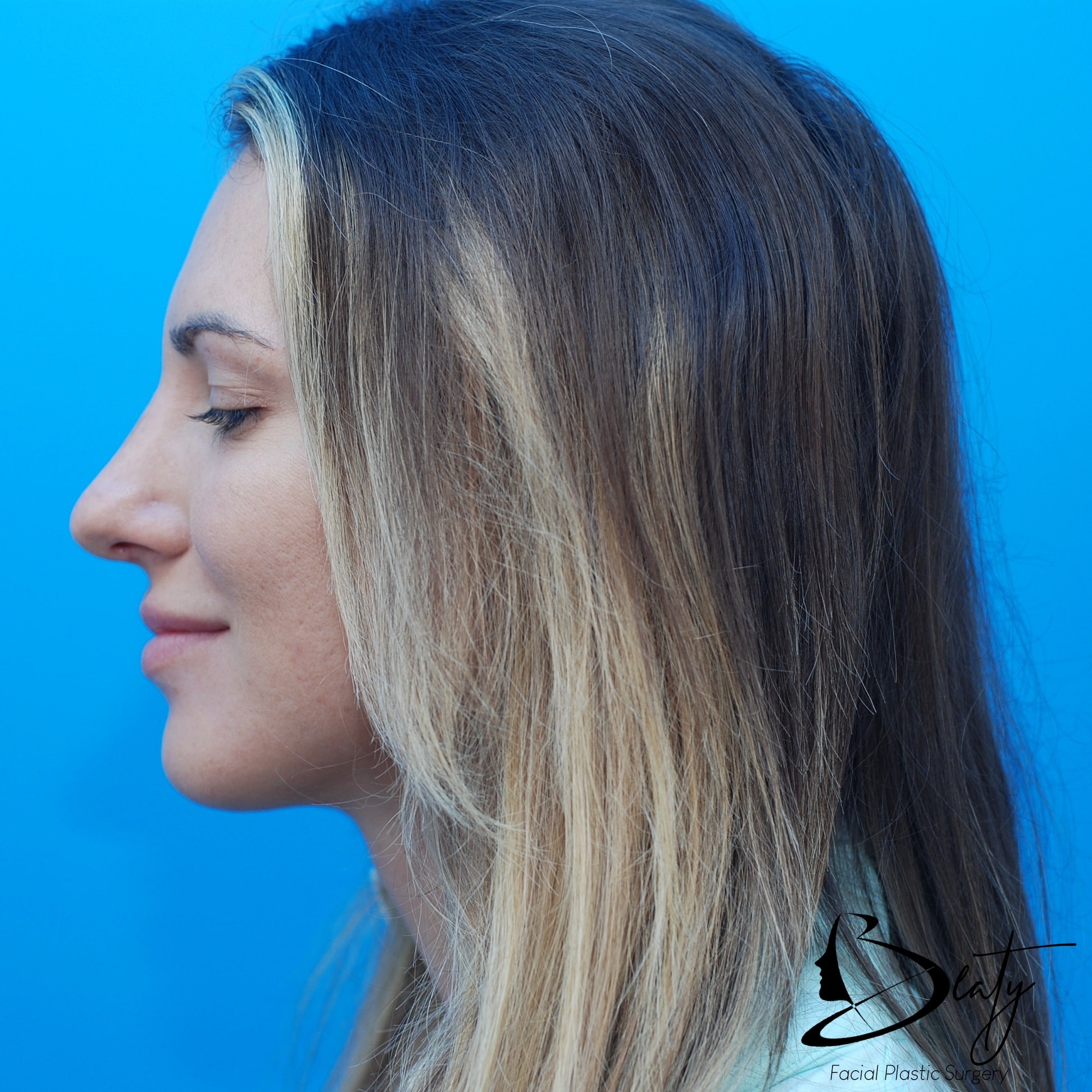 rhinoplasty