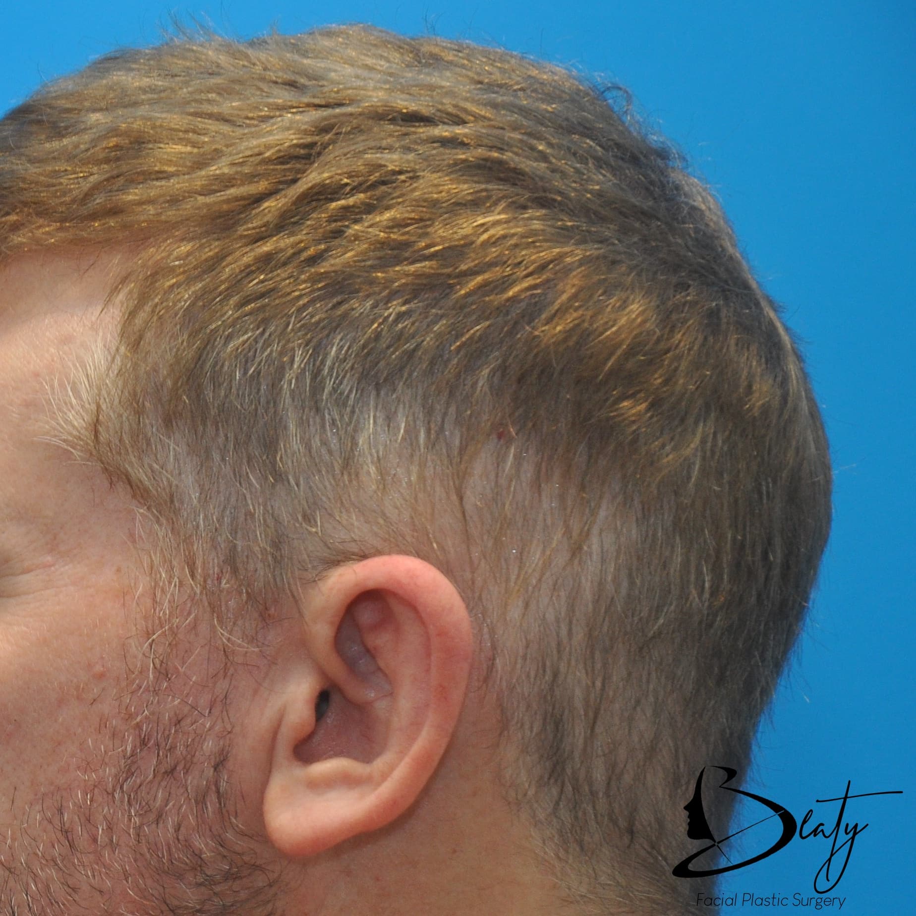 Before Image