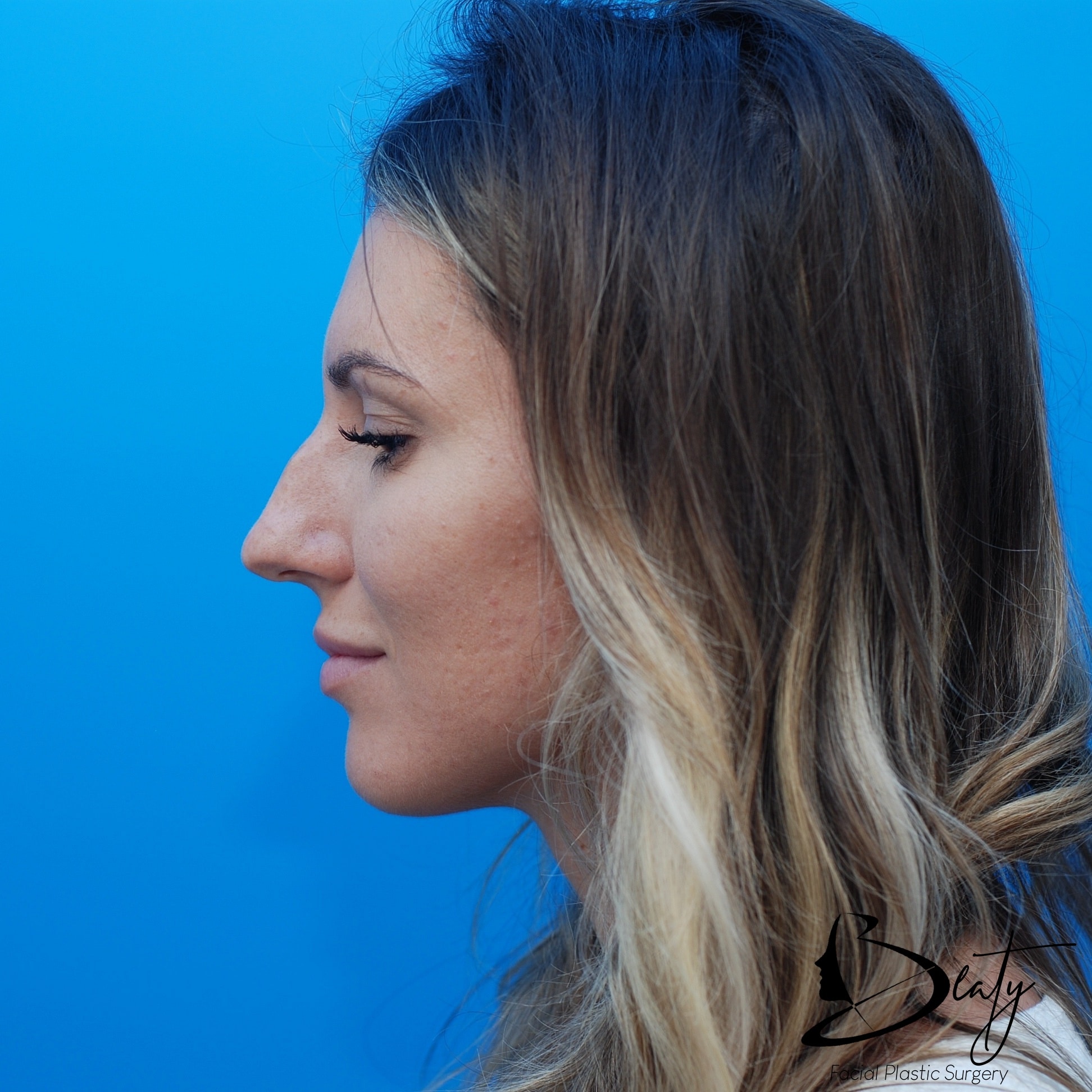 rhinoplasty