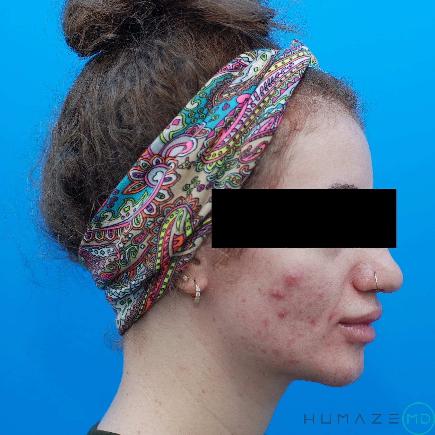 skin resurfacing