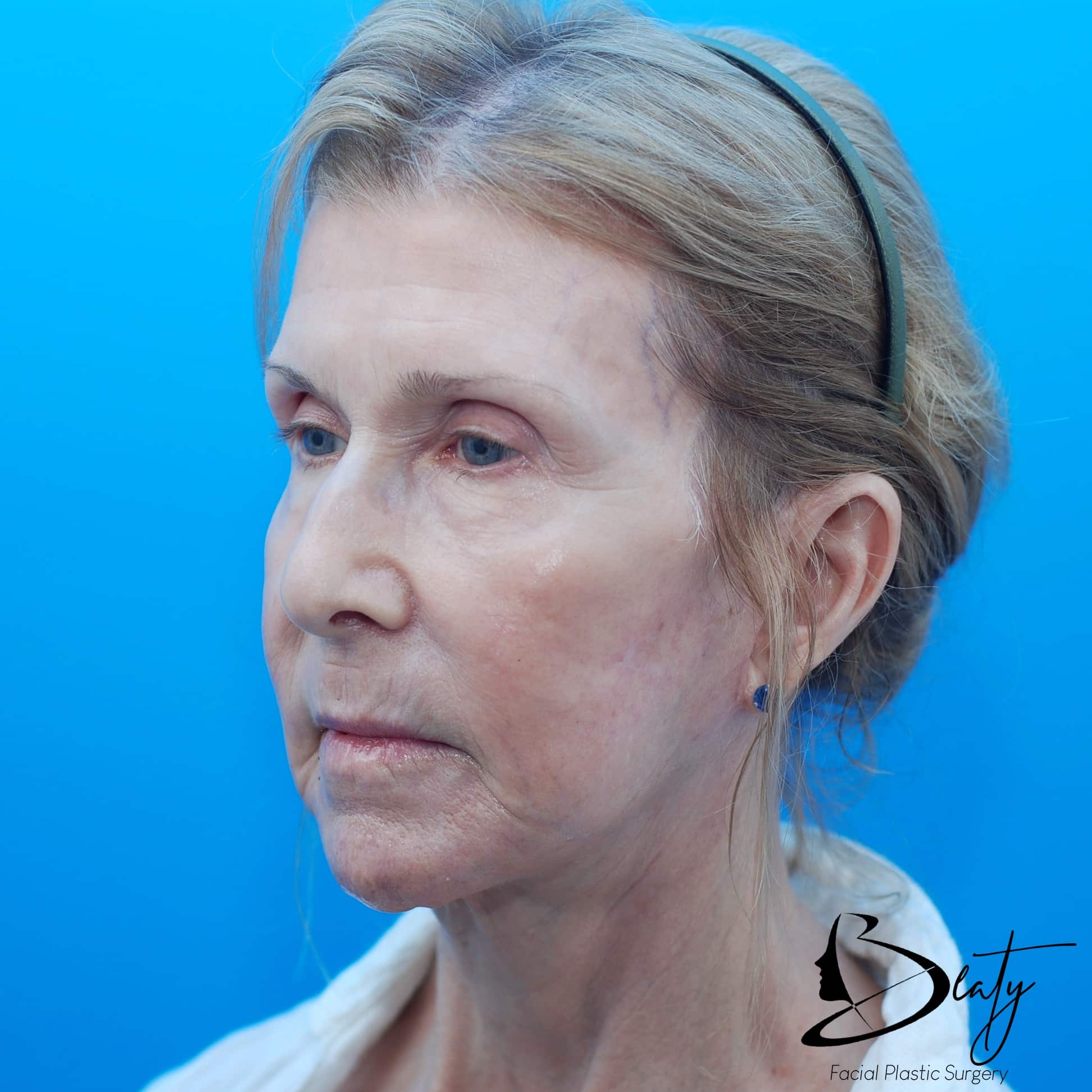 FACELIFT (PROLIFT™)