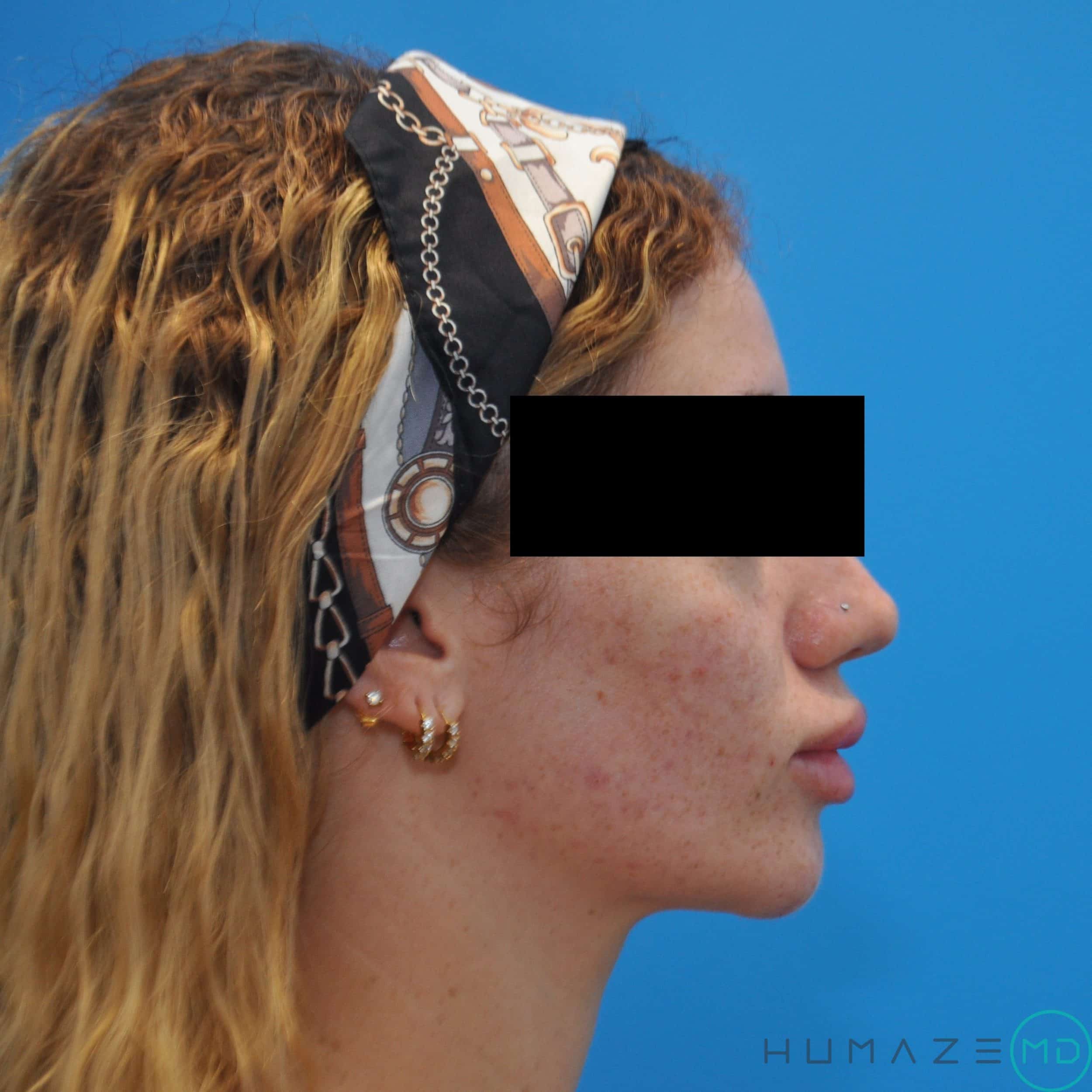 skin resurfacing