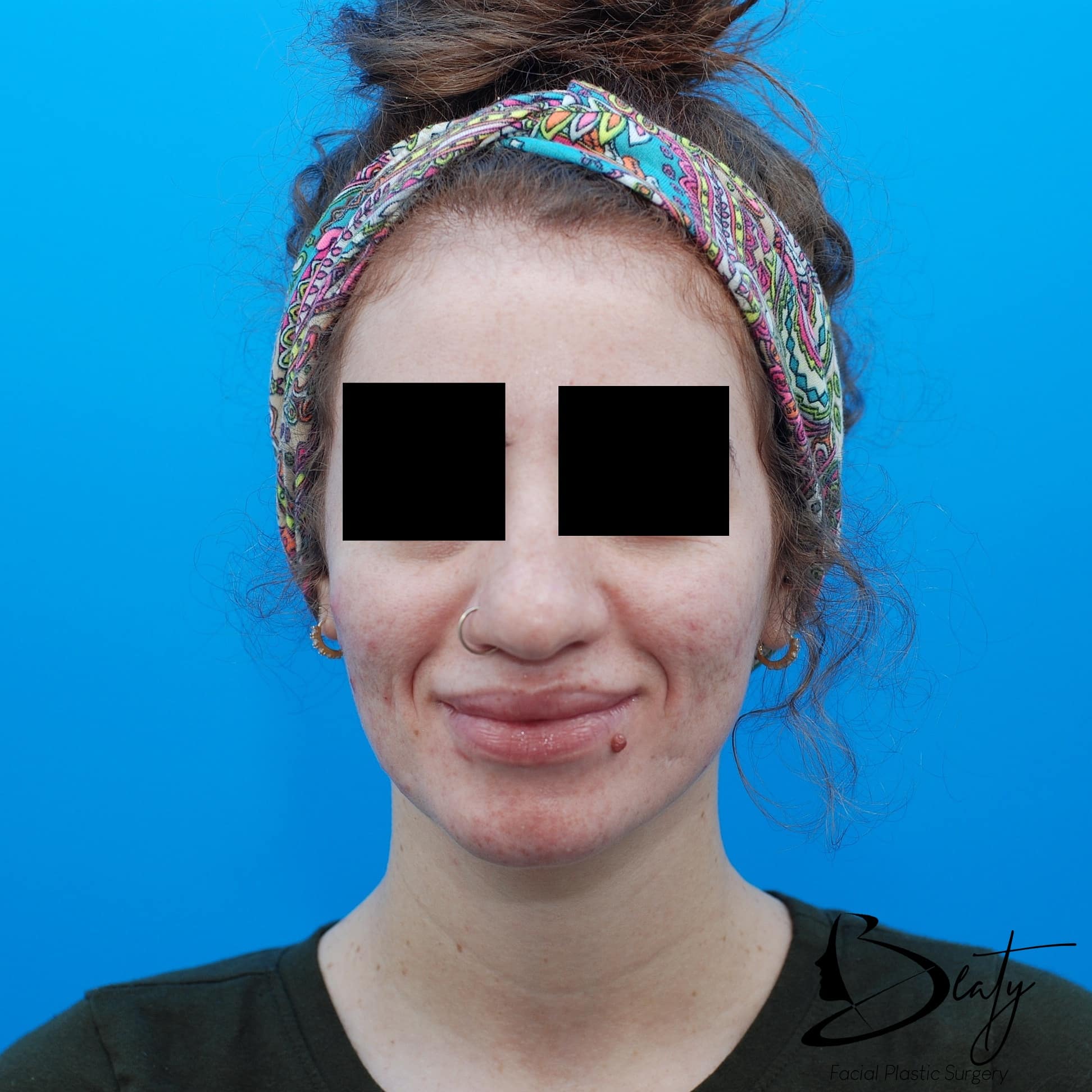 rhinoplasty