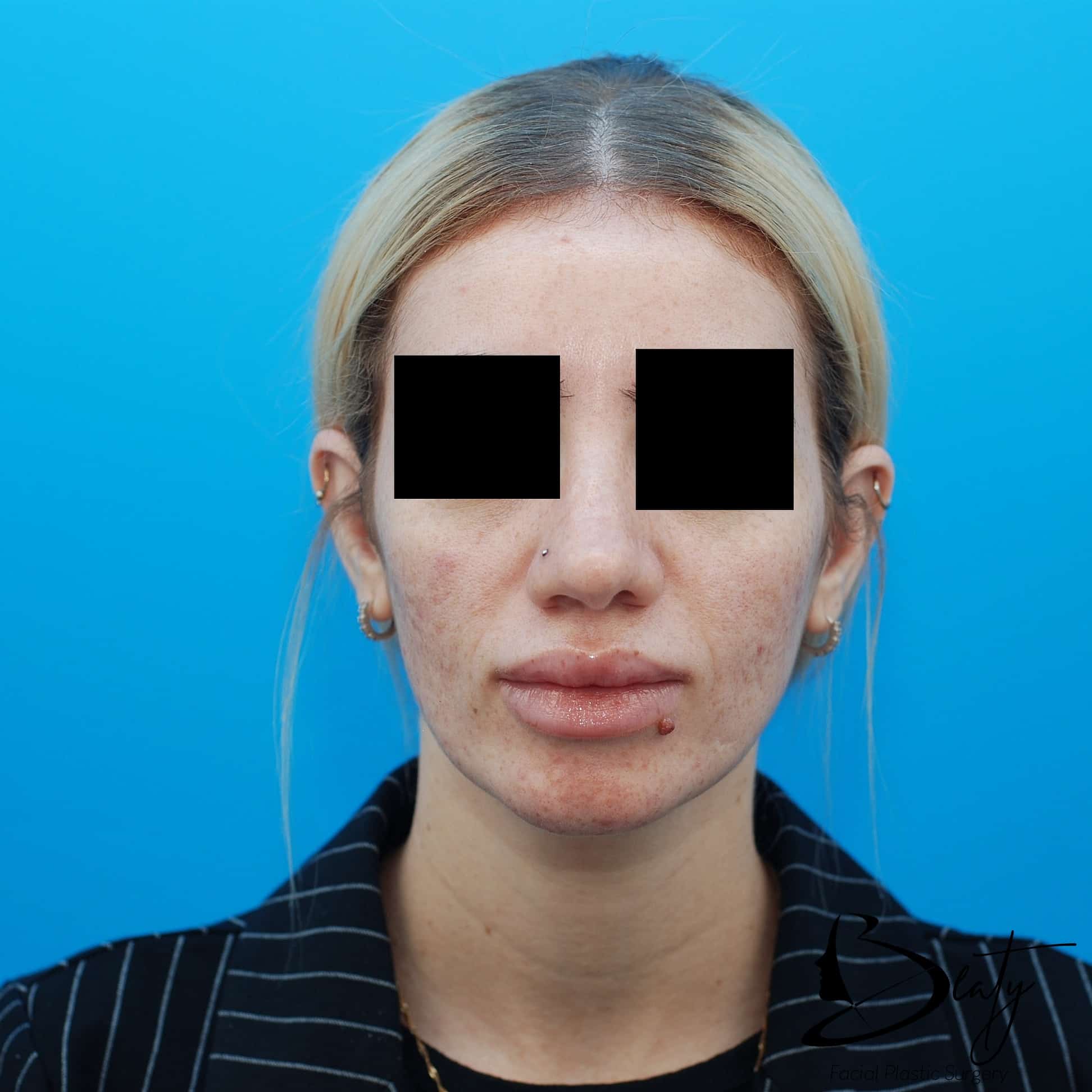 rhinoplasty