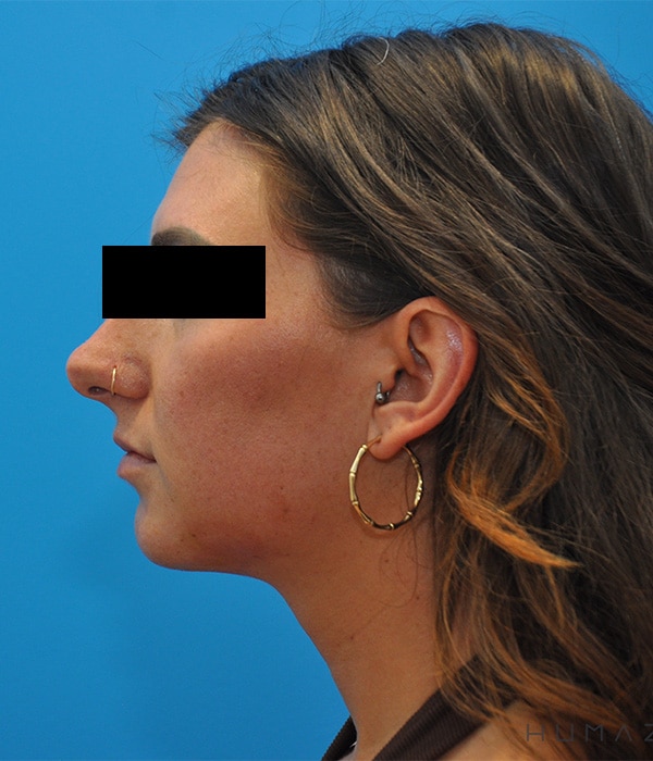 Chin Implant