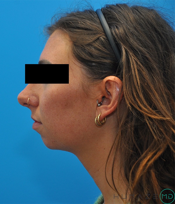 Chin Implant