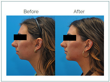 facial implant c9 featured case or before and after facial implant c9 featured case or before and after