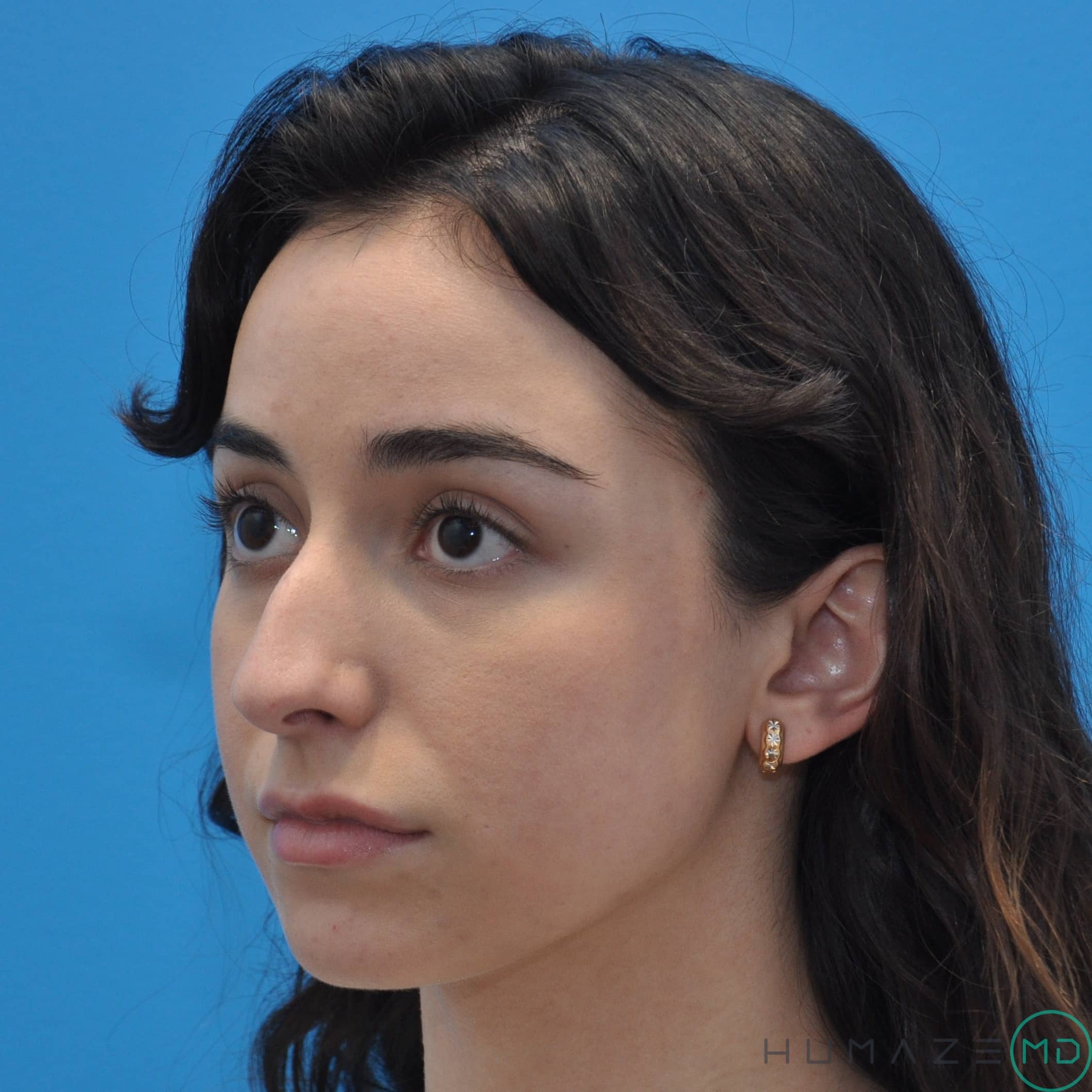 rhinoplasty