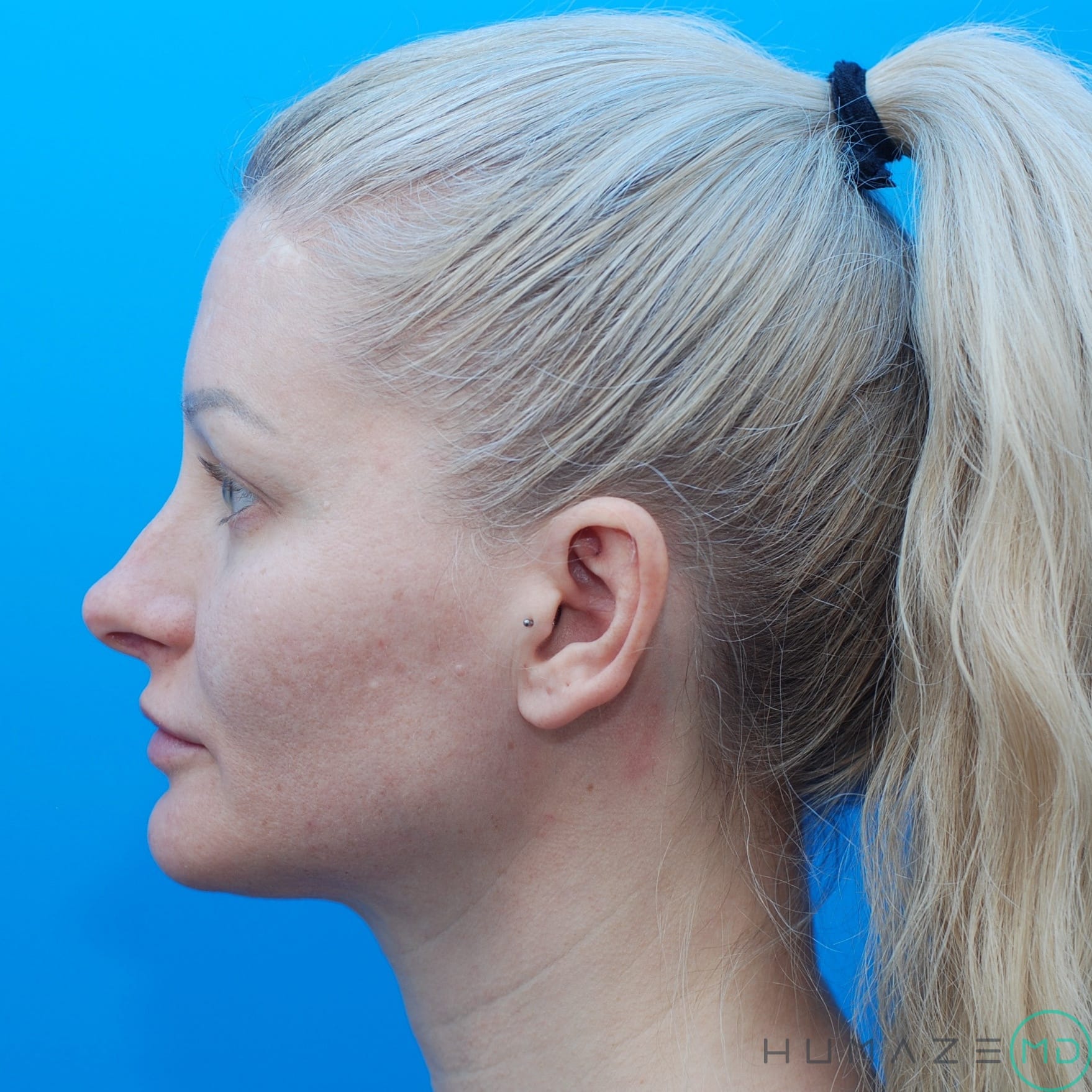 CO2 laser resurfacing