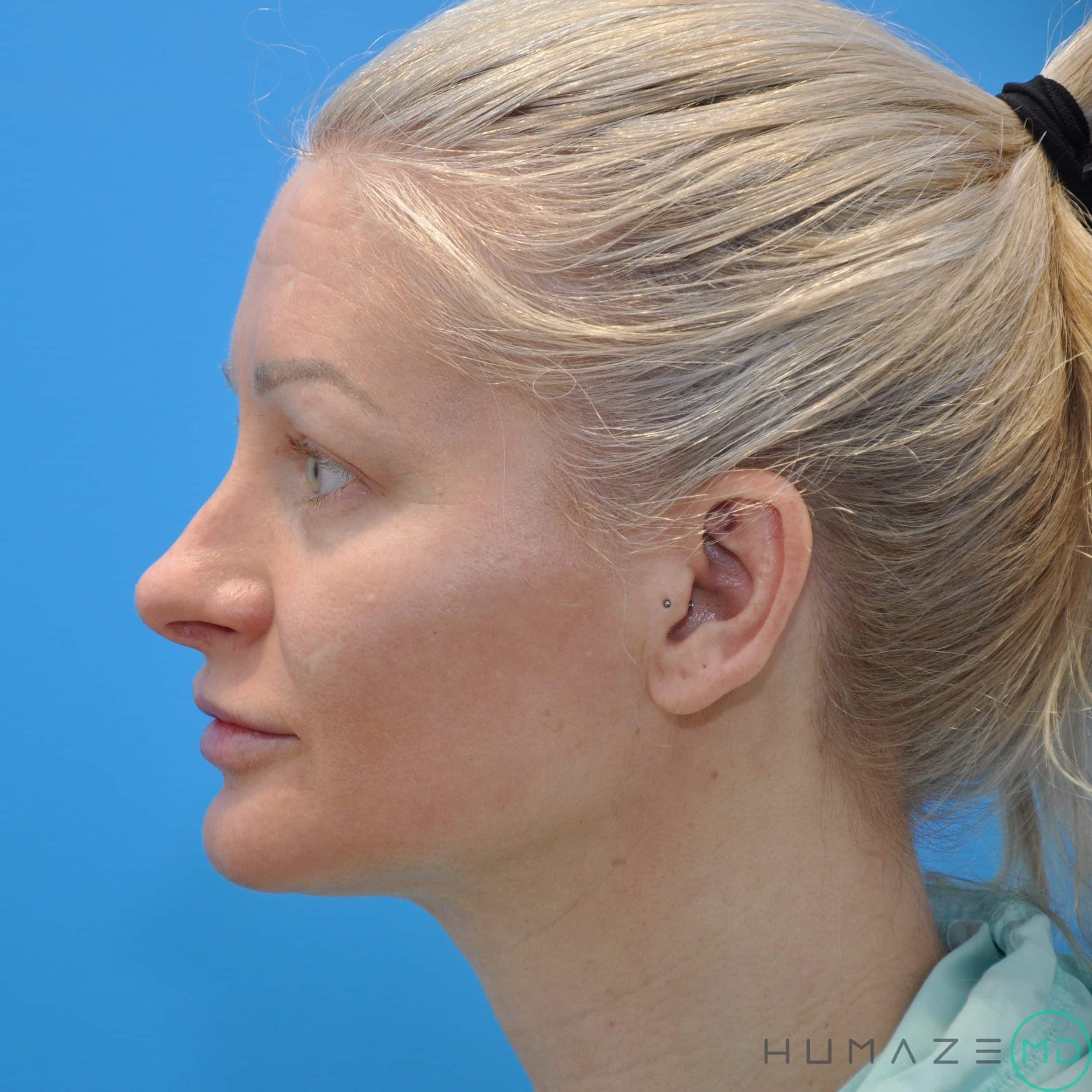 CO2 laser resurfacing