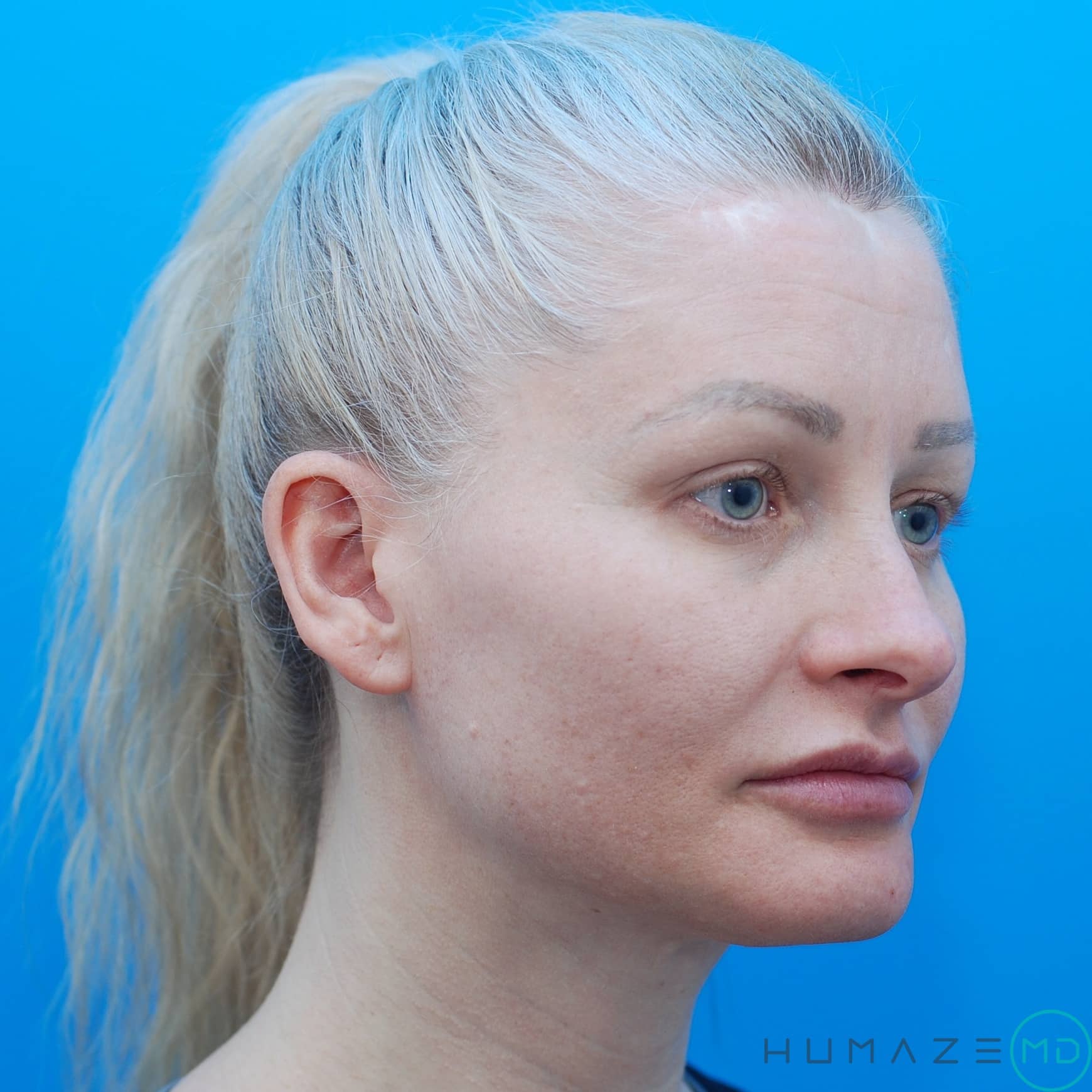 injectables & filler