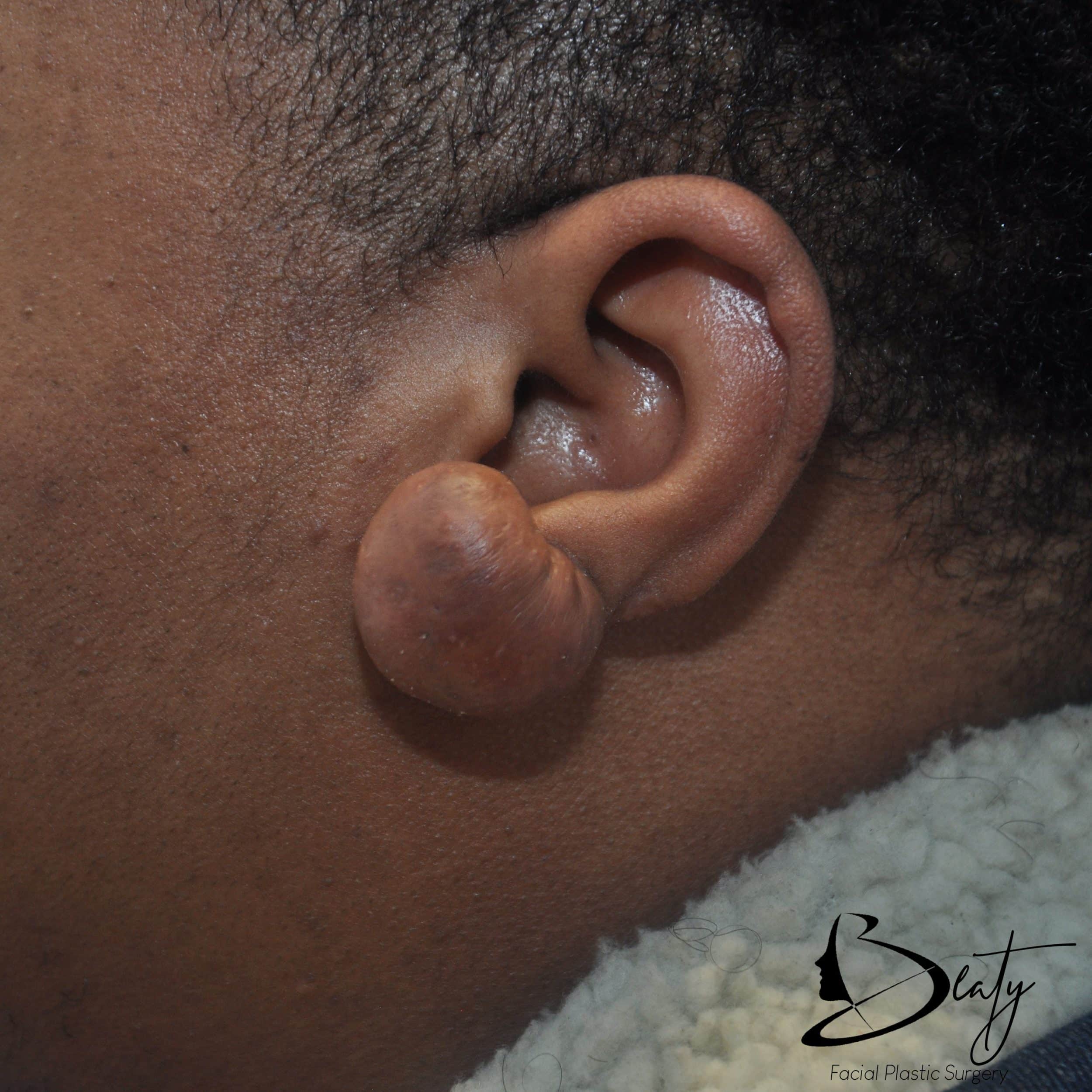 keloid scar removal
