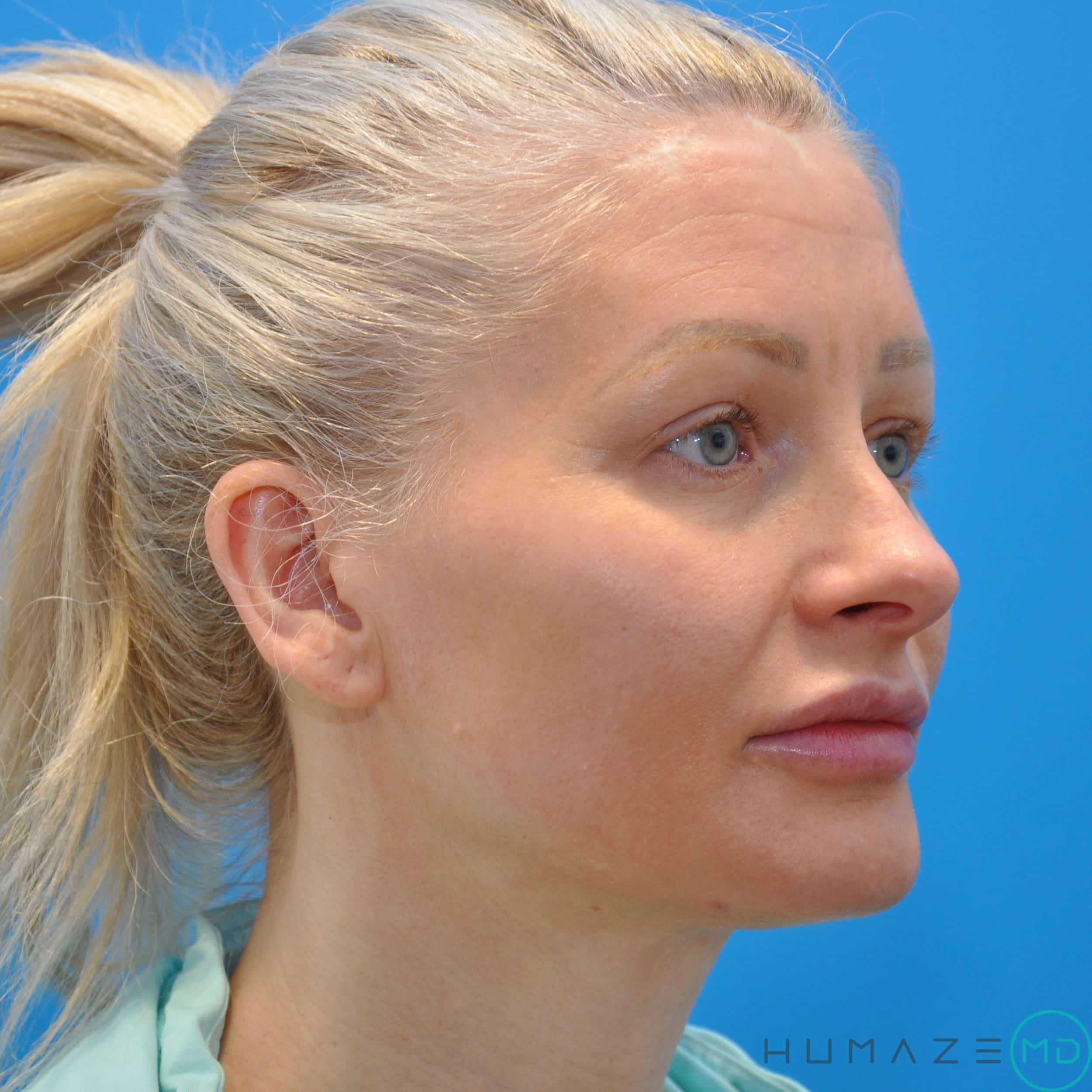 injectables & filler