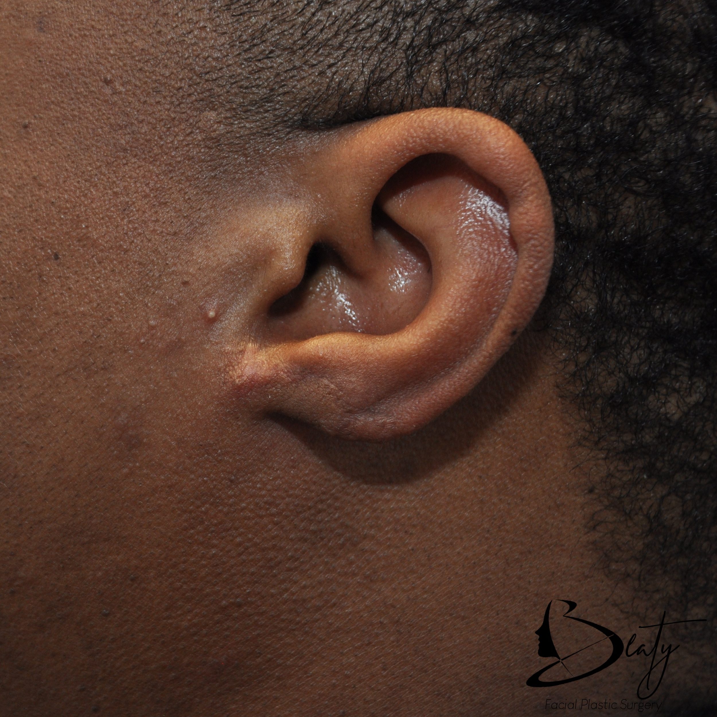 keloid scar removal