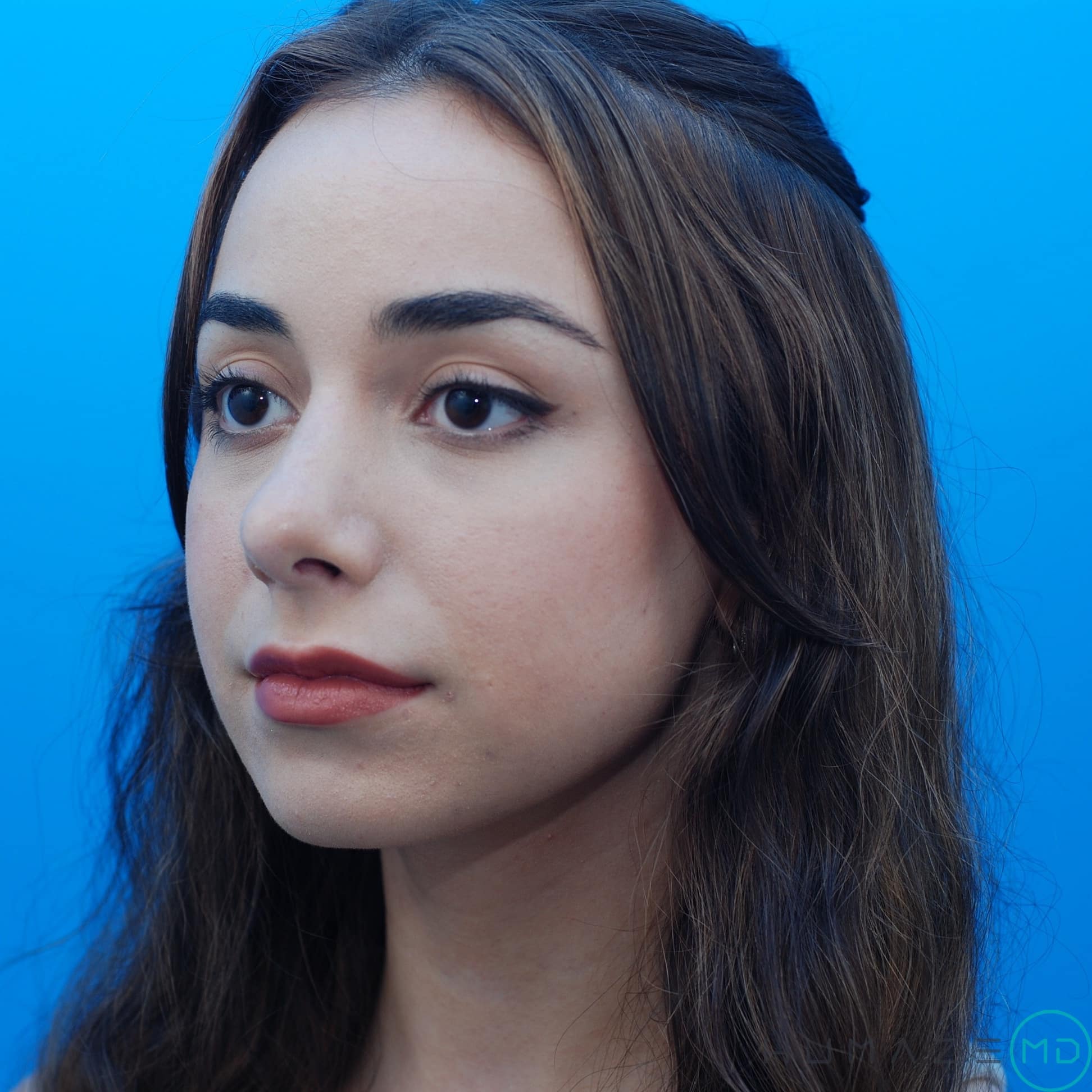 rhinoplasty
