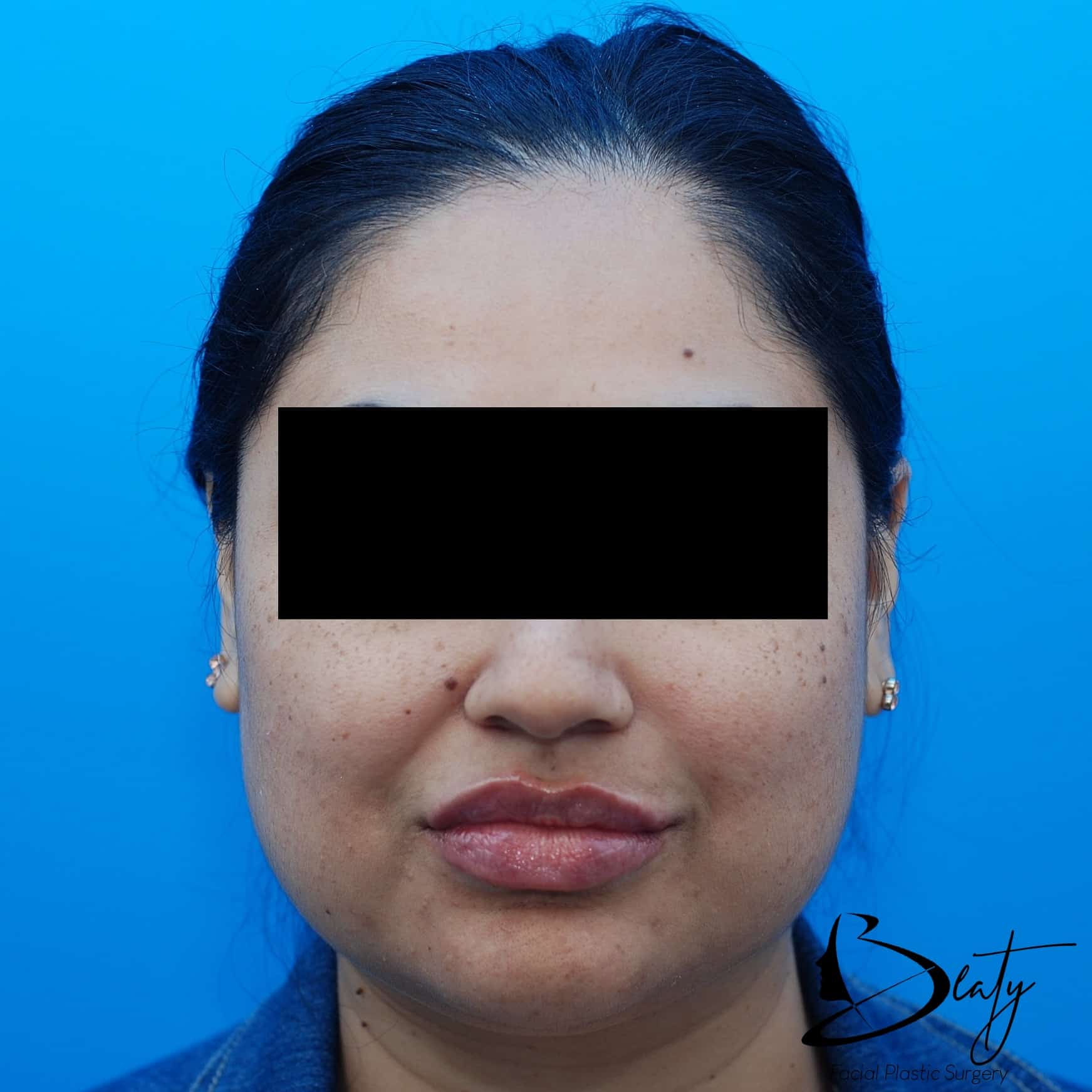 fillers & injectables