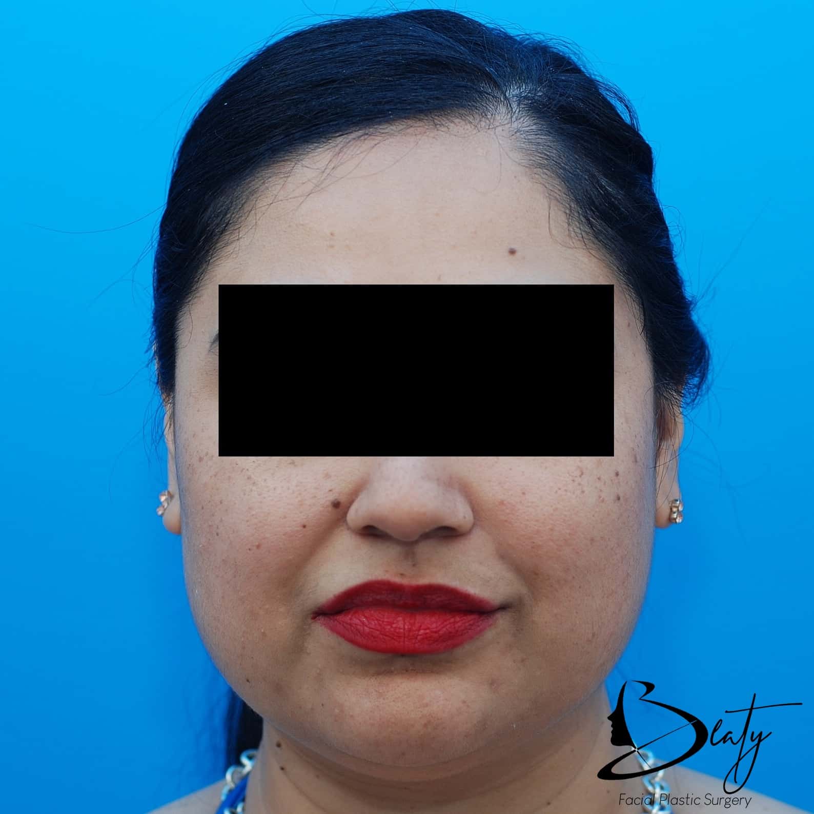 fillers & injectables