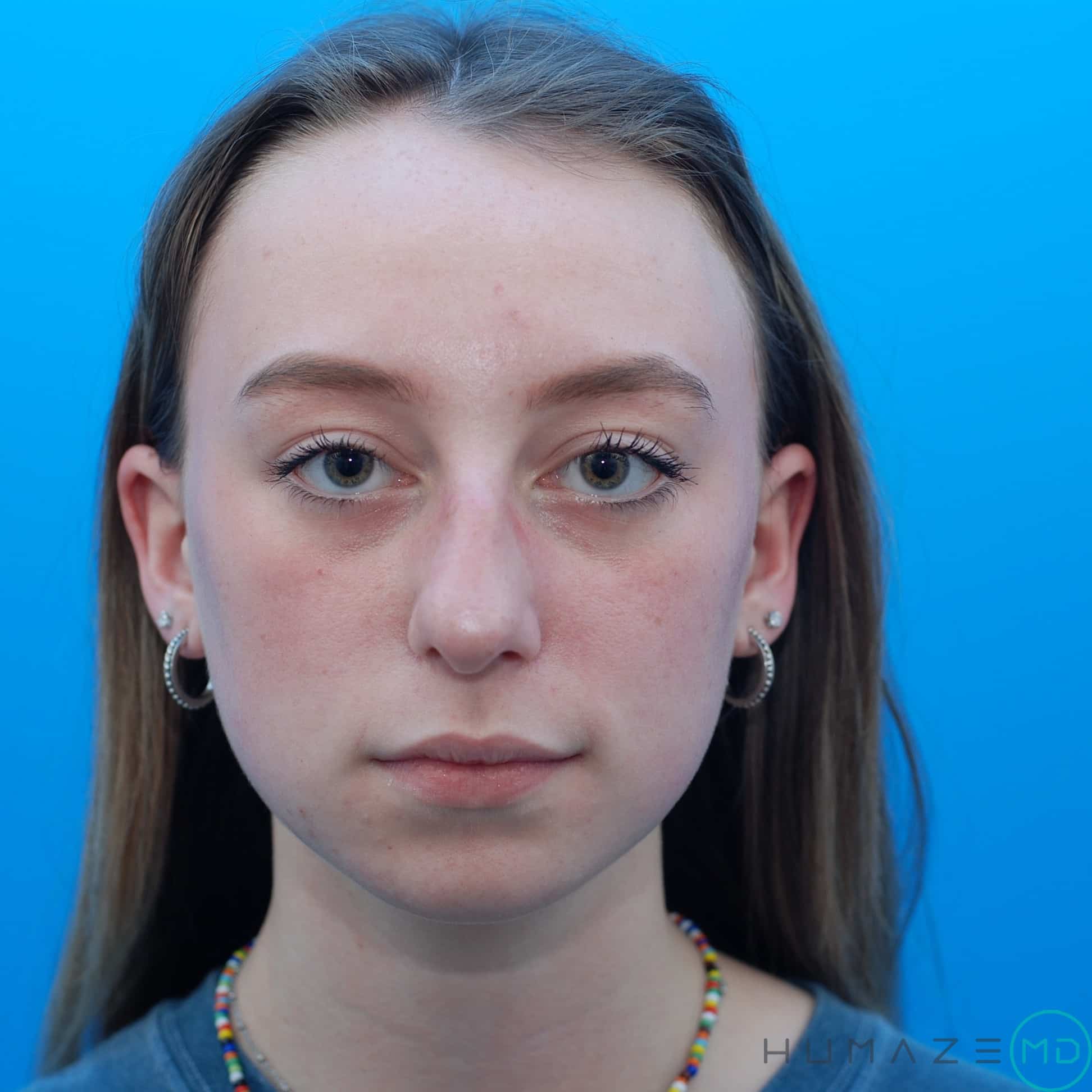 rhinoplasty