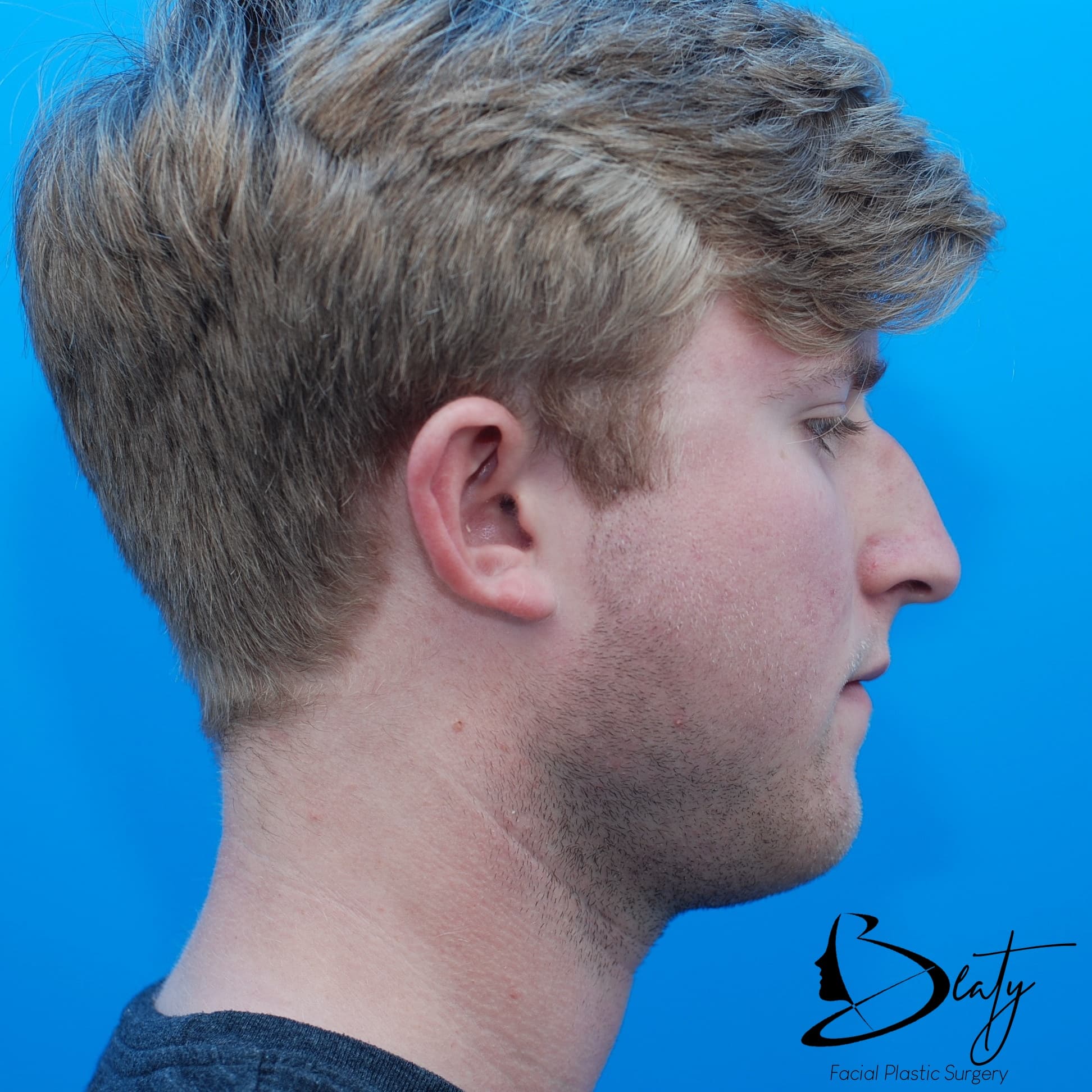rhinoplasty