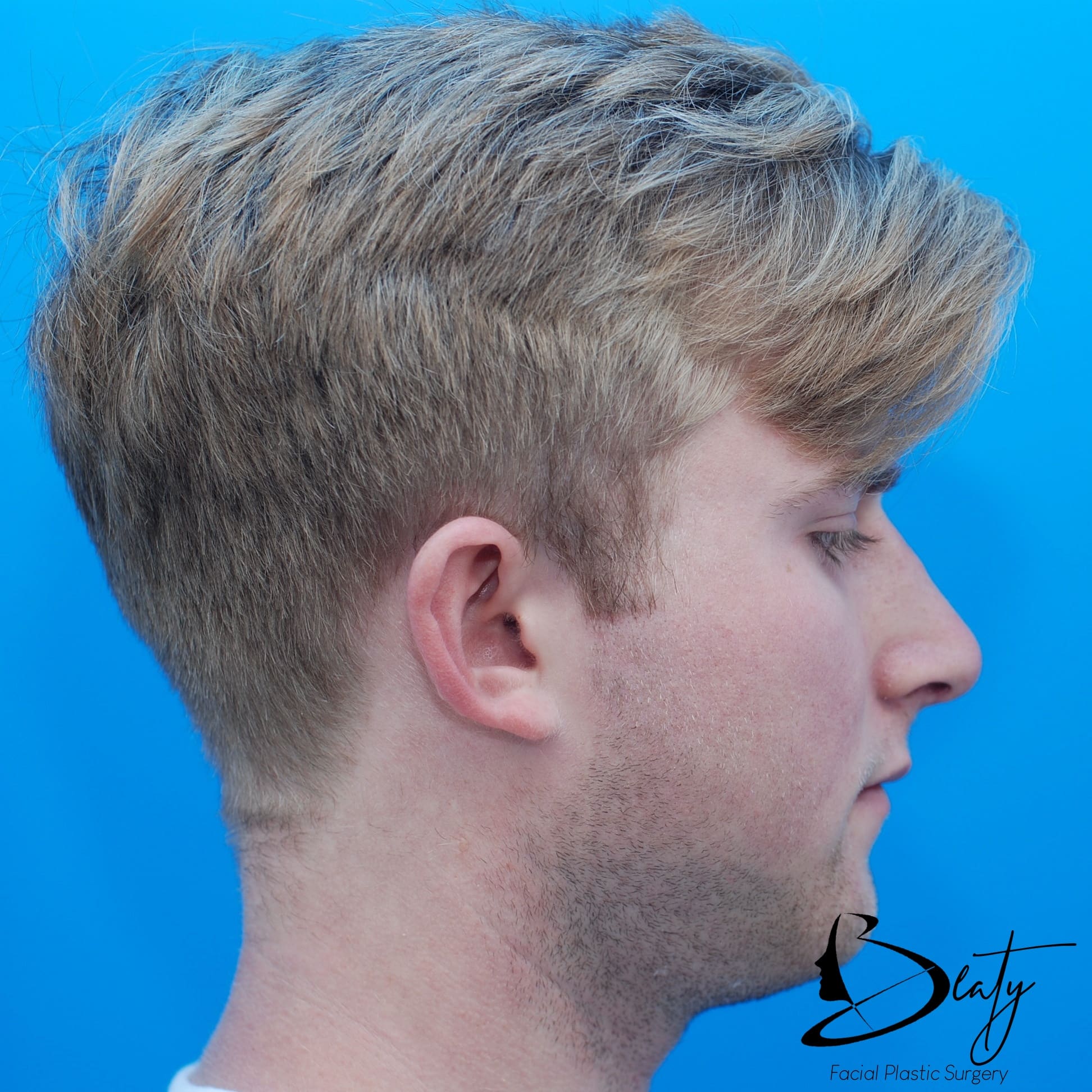 rhinoplasty