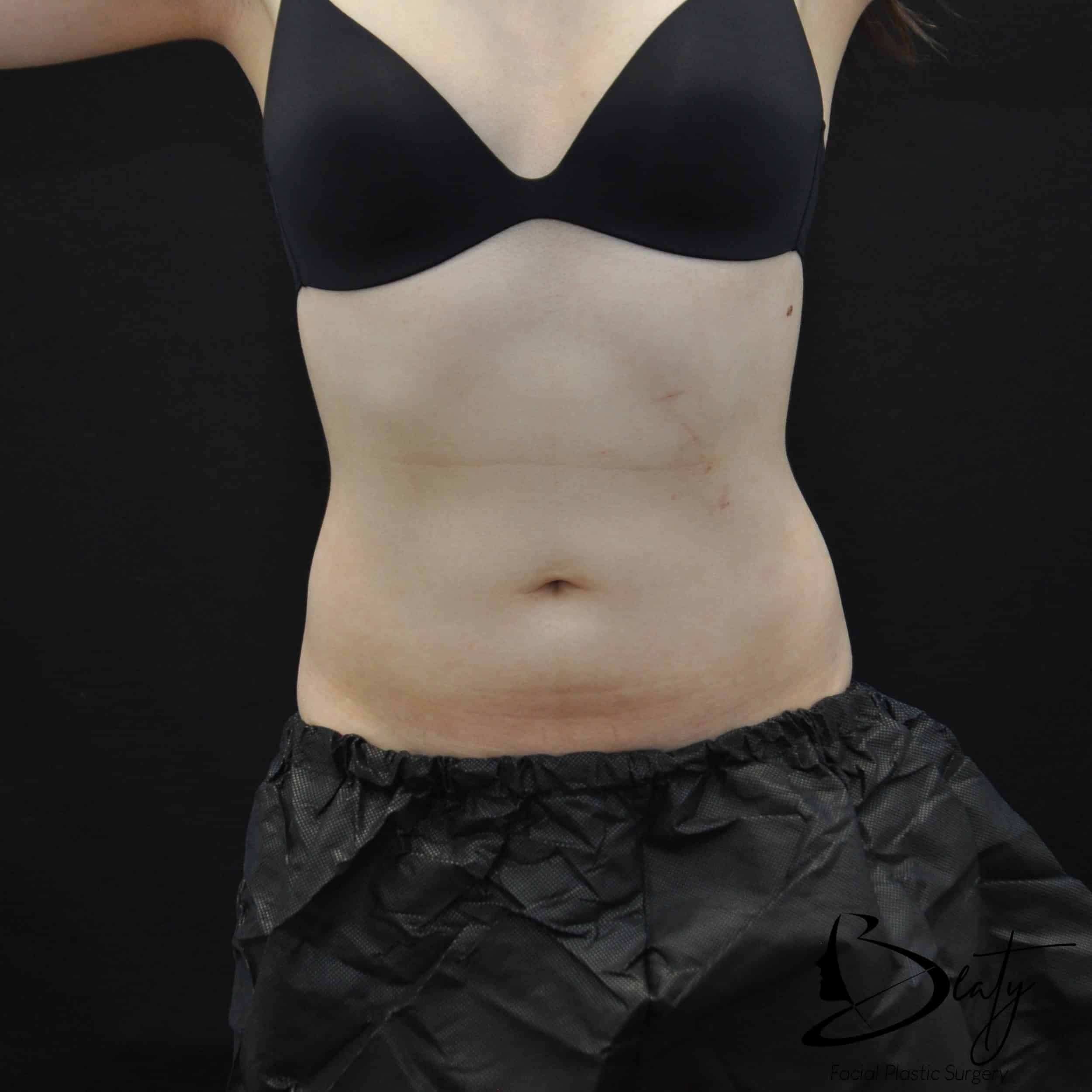 coolsculpting & cooltone