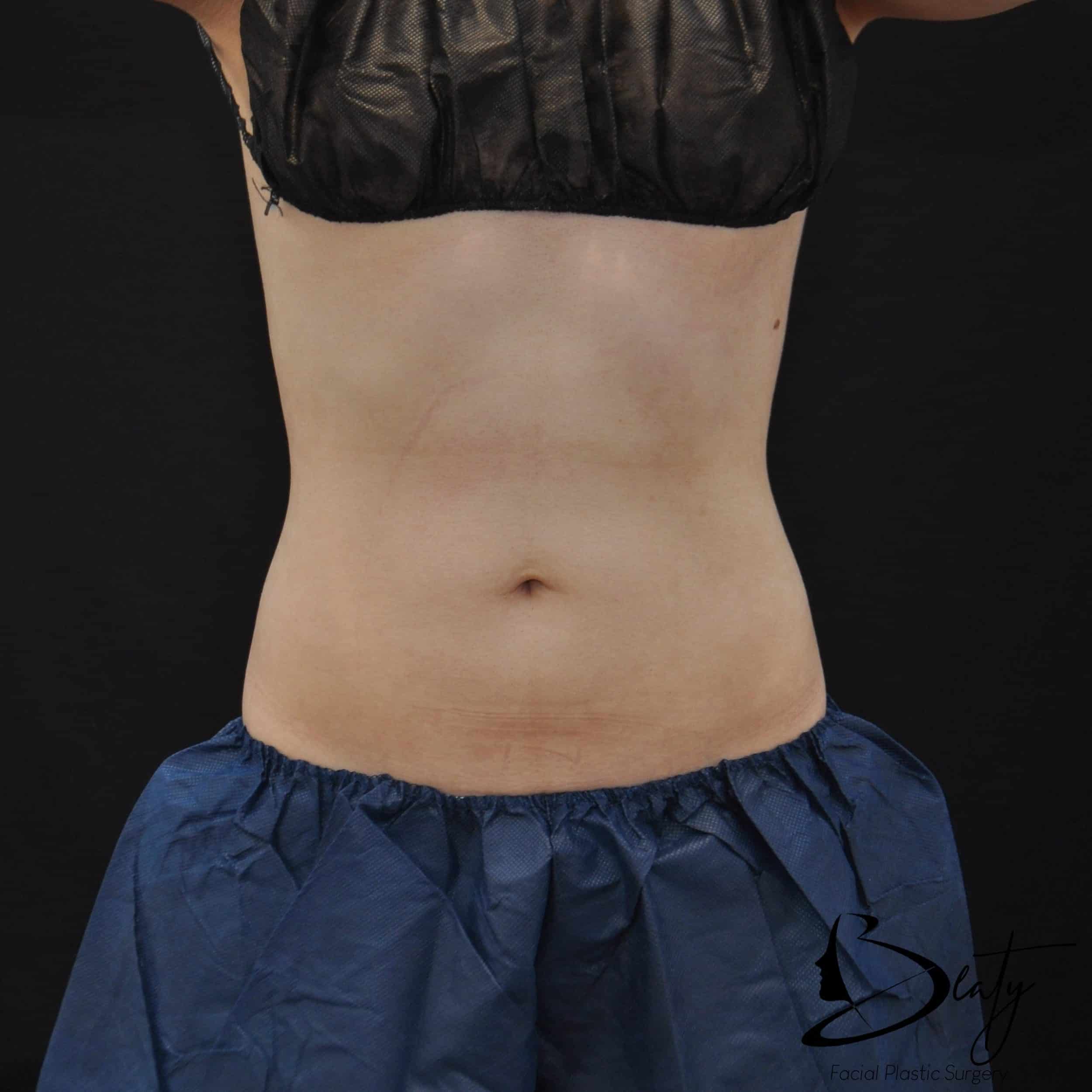 coolsculpting & cooltone