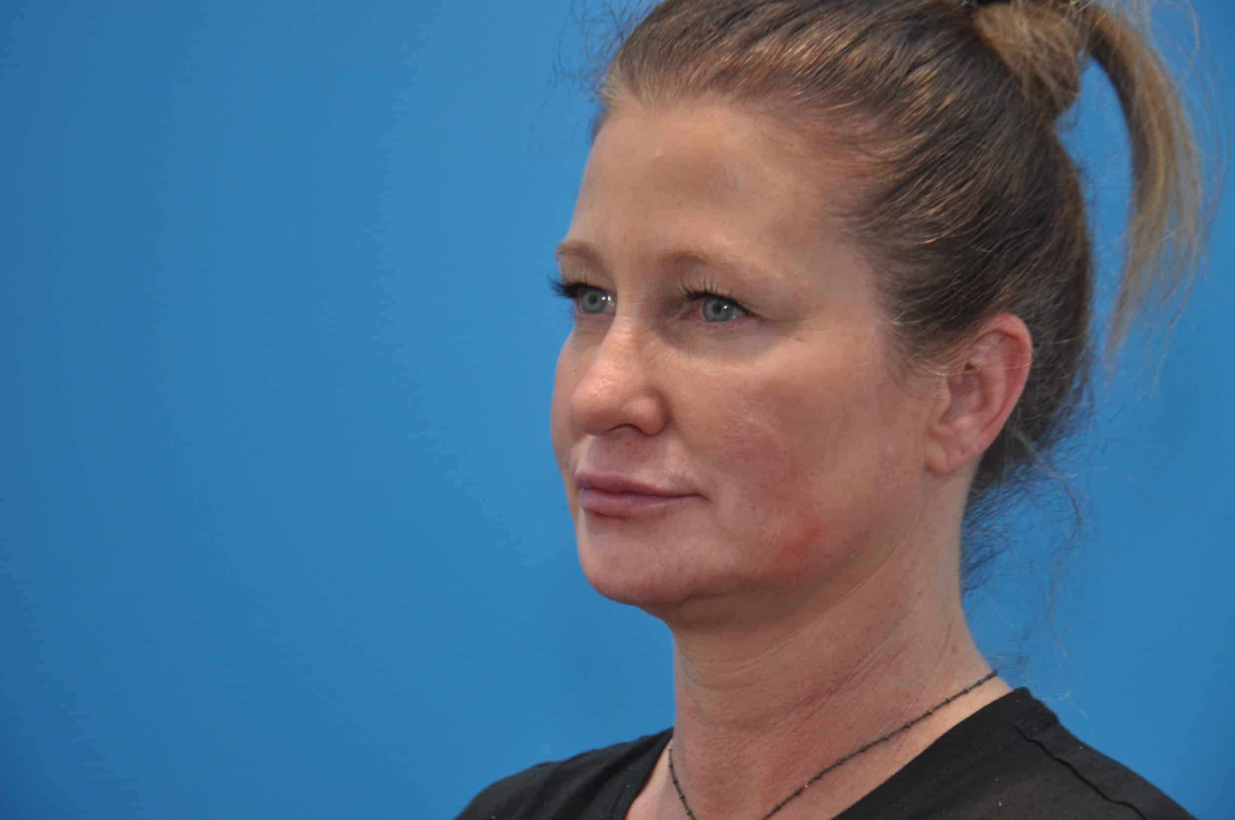injectables & filler
