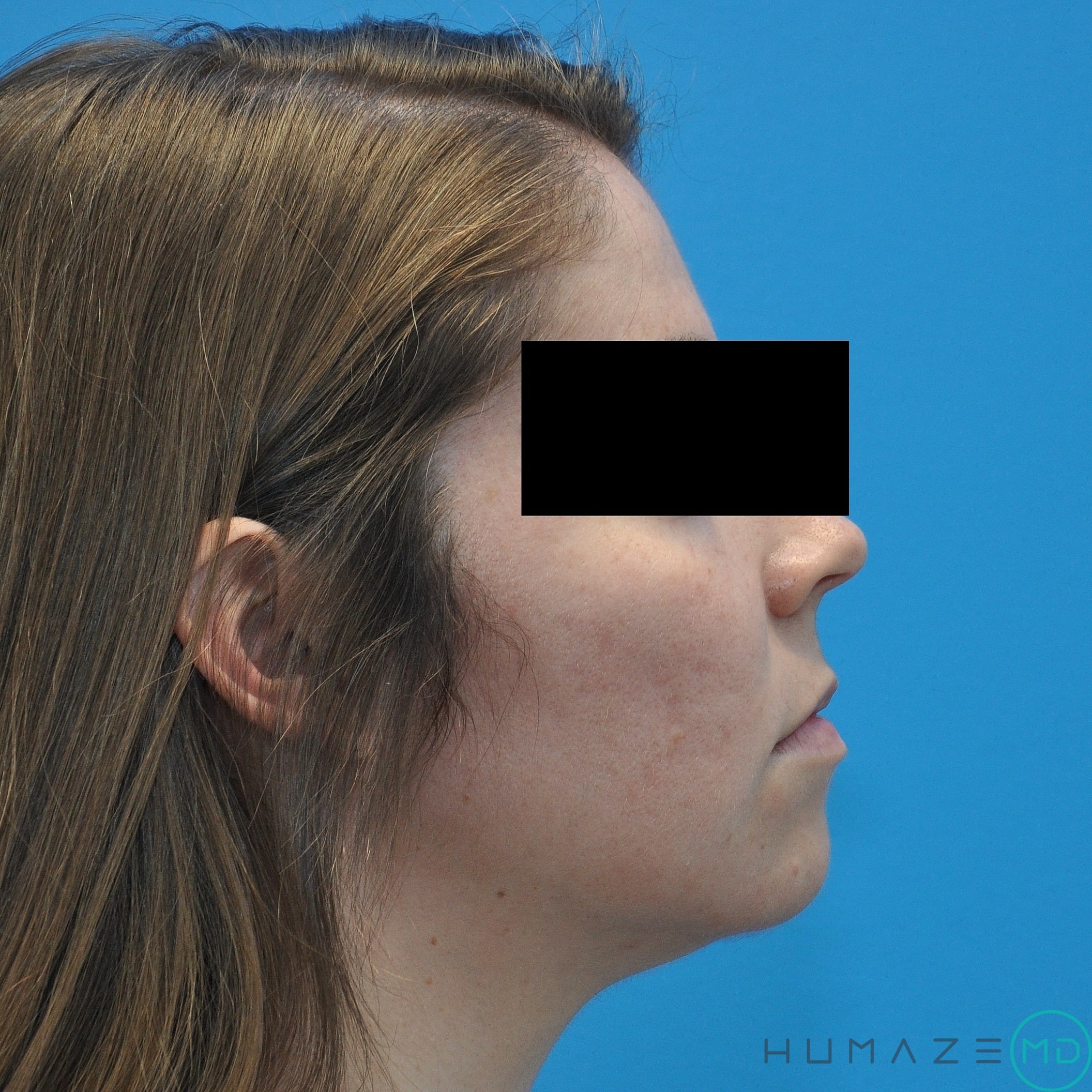 CO2 laser resurfacing