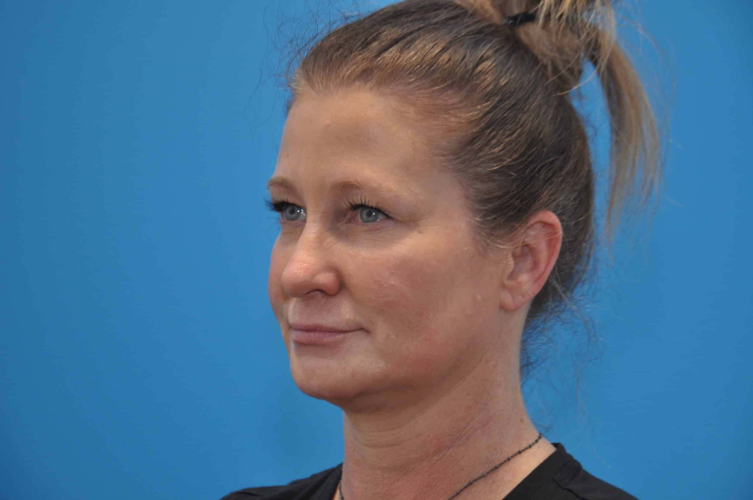 injectables & filler