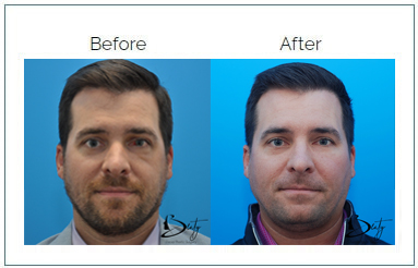 facial implants1 facial implants1